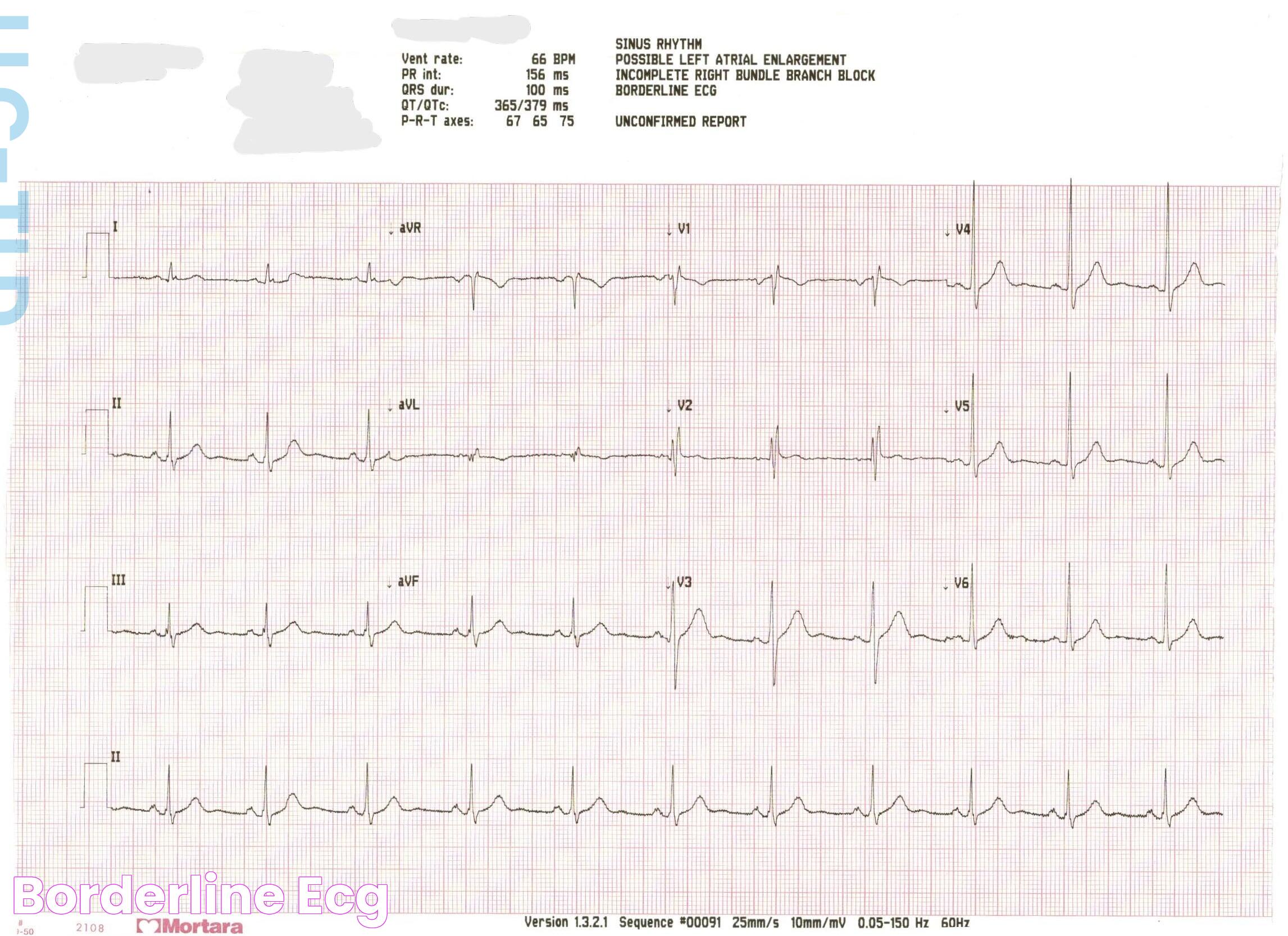 Borderline ECG Meaning: A Detailed Guide For Better Understanding