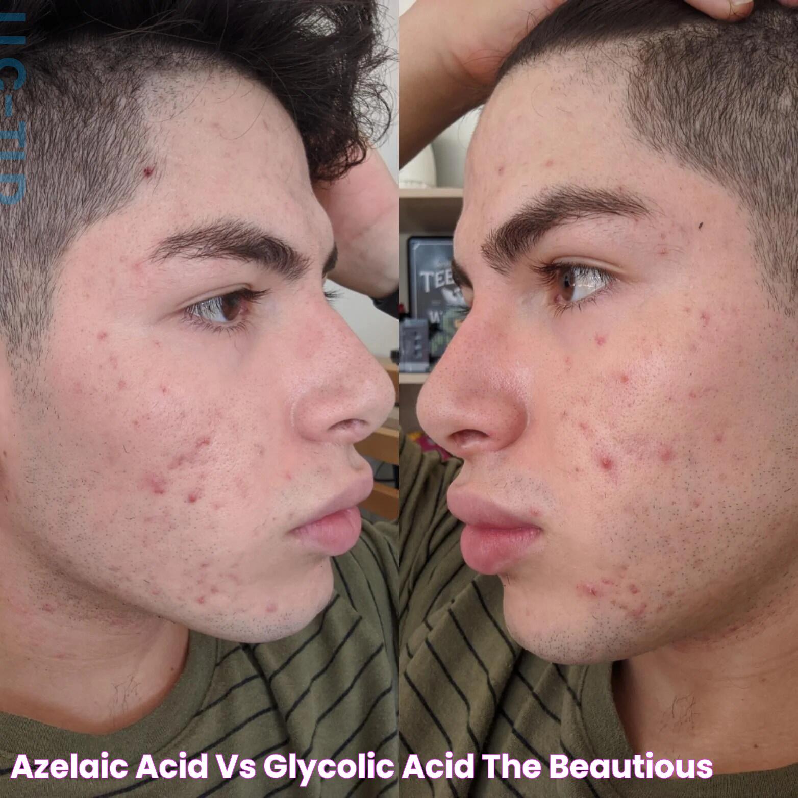 Glycolic Acid Vs AHA: A Comprehensive Guide To Skincare Acids