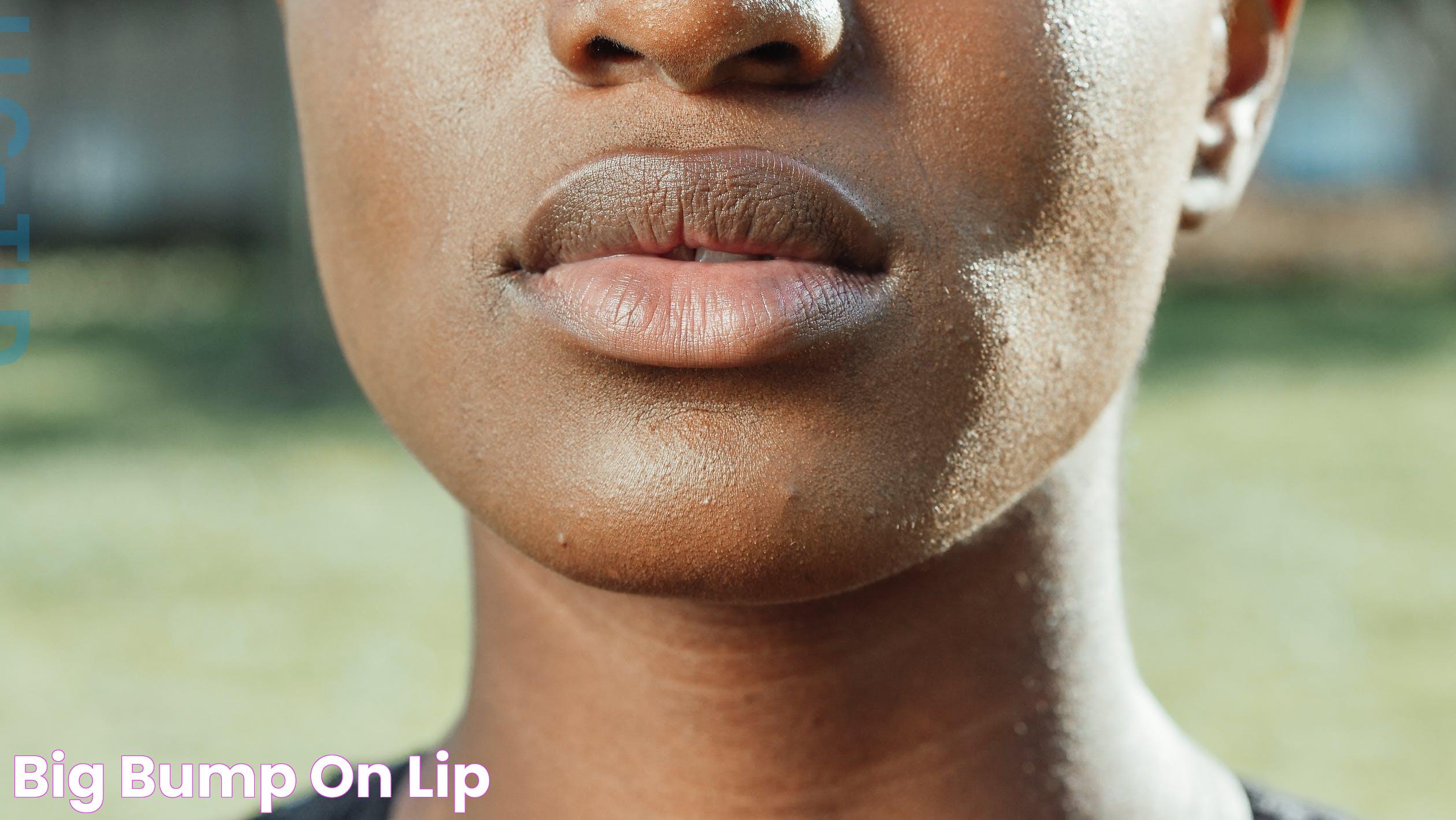 Comprehensive Guide To Lip Bump White: Causes, Treatments, And Prevention