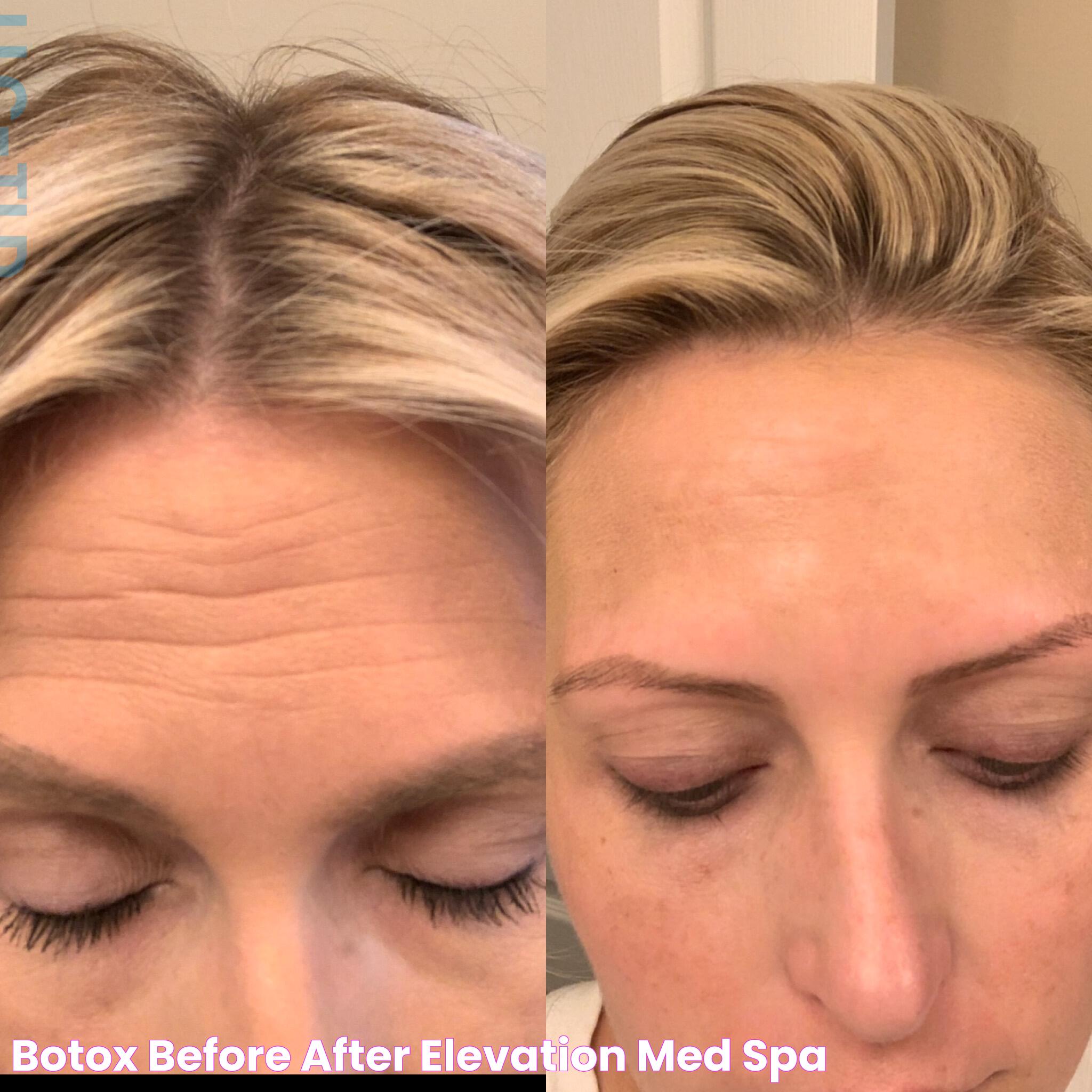 Botox Before After Elevation Med Spa