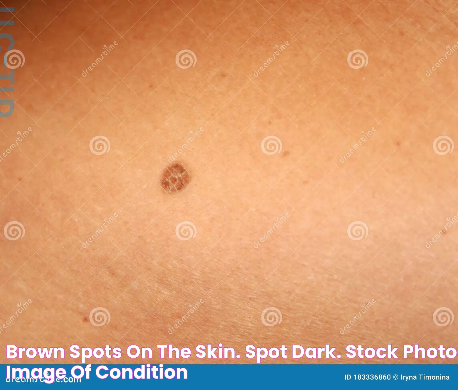 Brown Spots on the Skin. Spot Dark. Stock Photo Image of condition