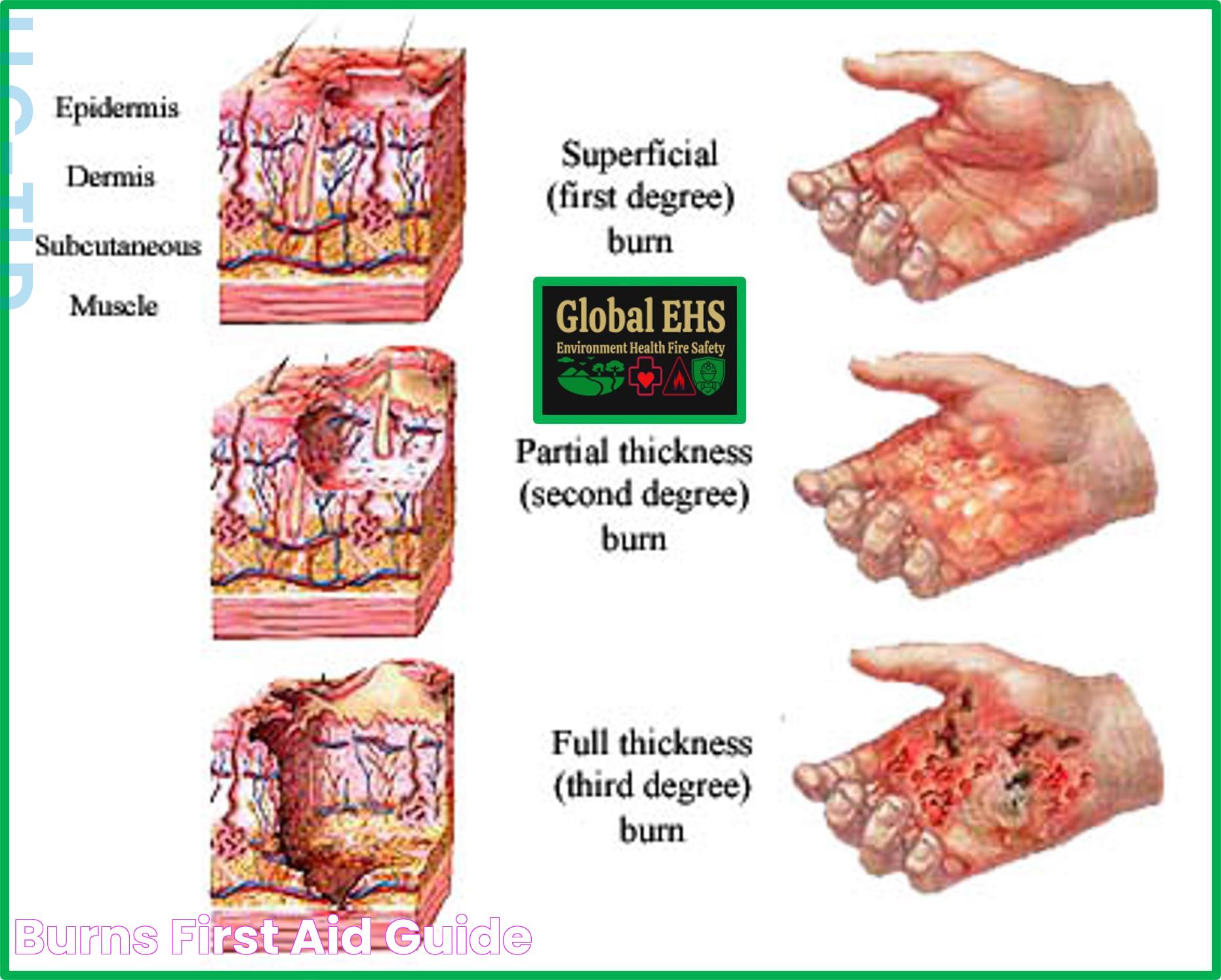 Comprehensive Guide To The Degrees Of Burns: Causes, Symptoms, And Treatment Options