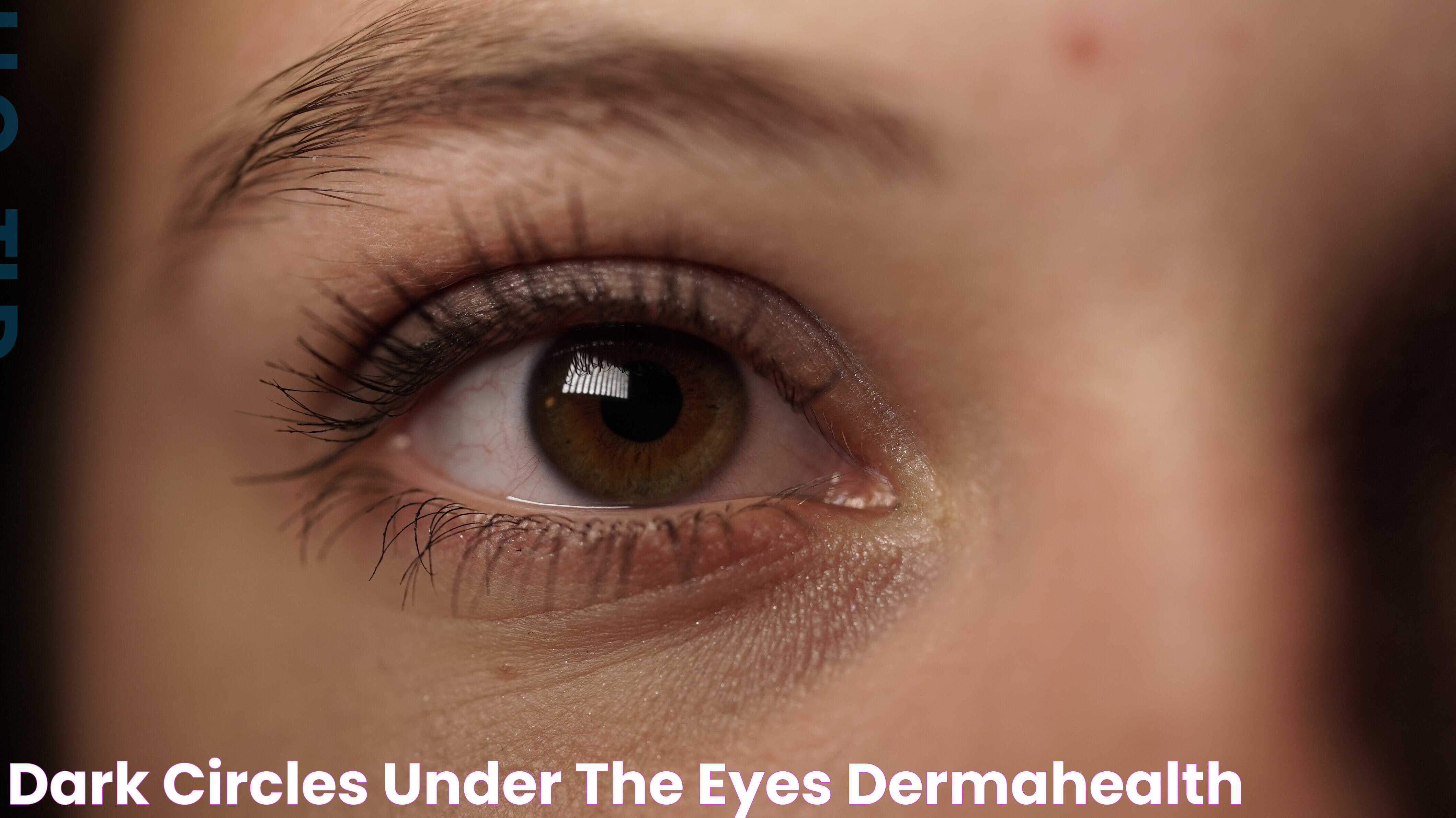 Dark circles under the eyes DermaHealth