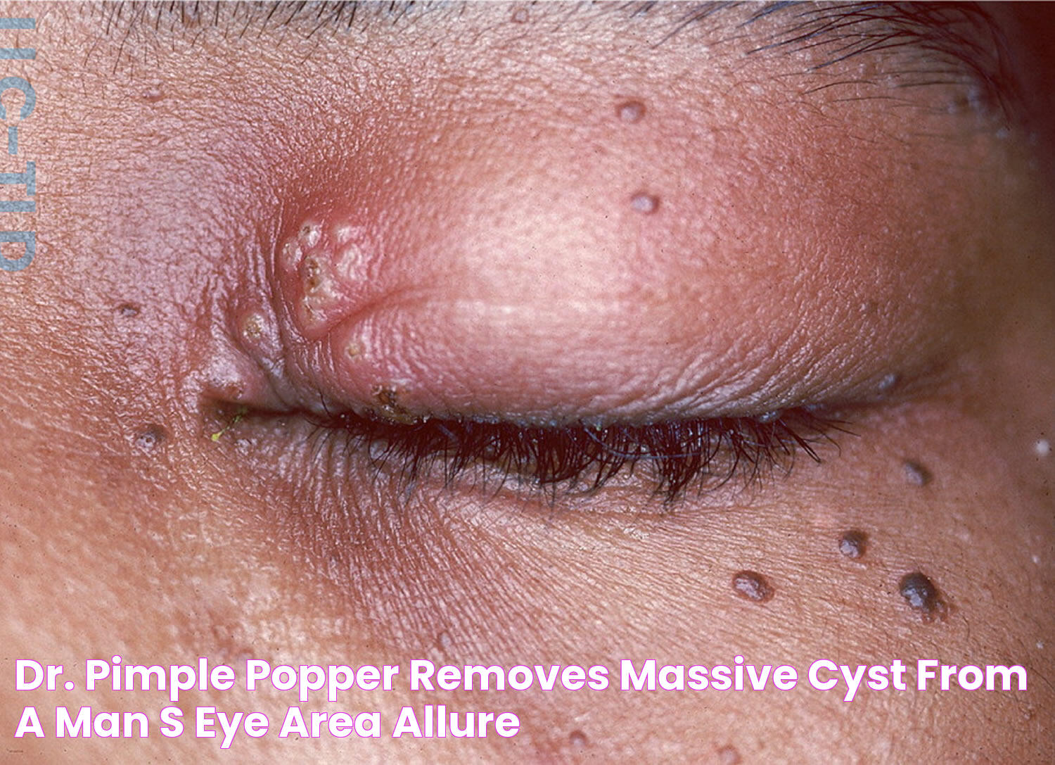 Effective Ways To Manage And Treat A Pimple In Your Eye