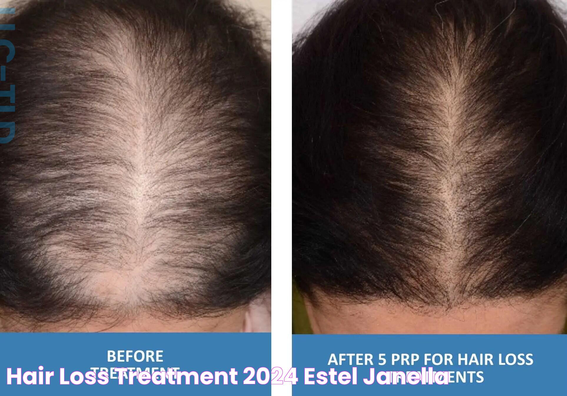 Hair Loss Treatment 2024 Estel Janella