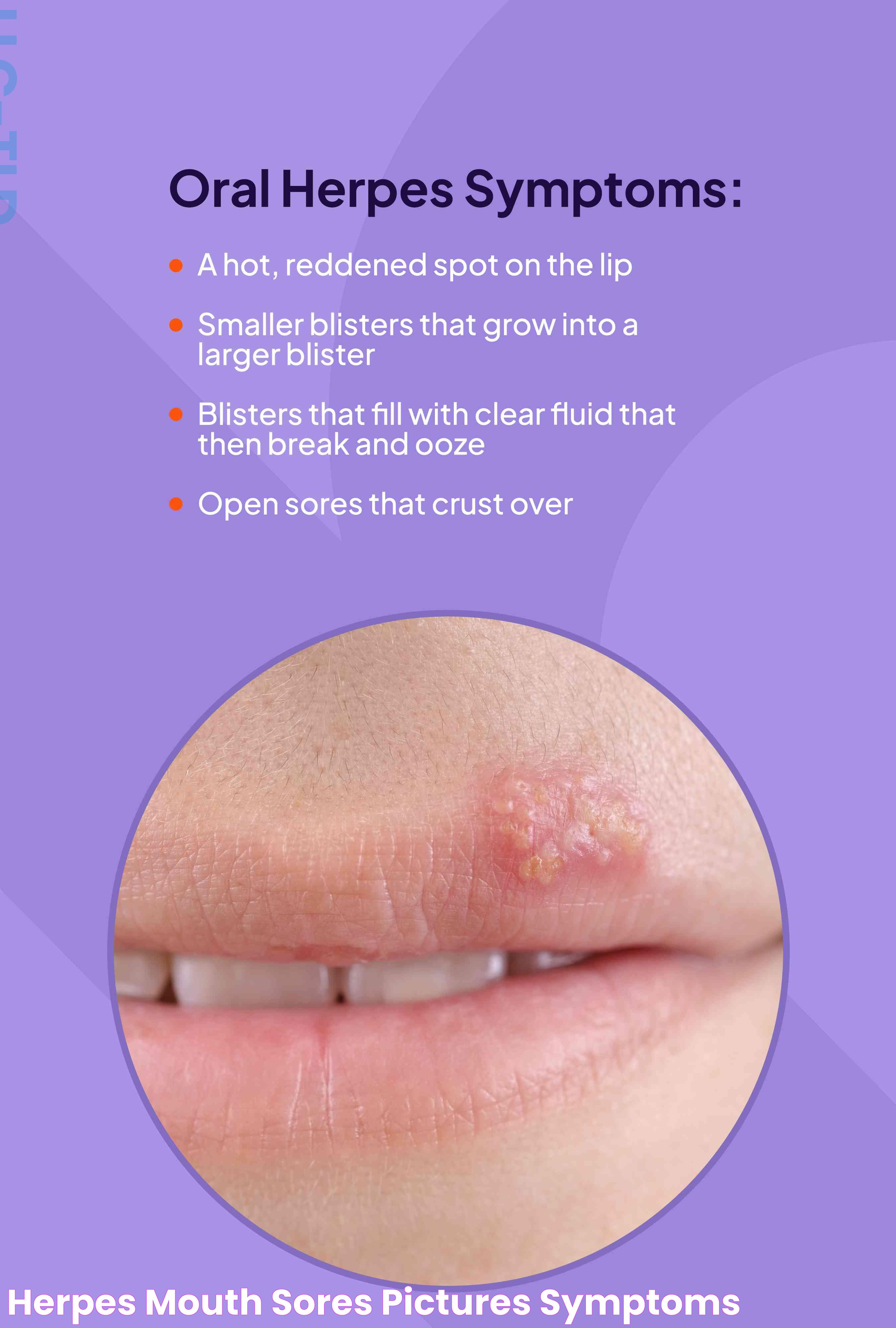 Signs Of Oral Herpes: What Do Herpes Look Like On The Mouth?