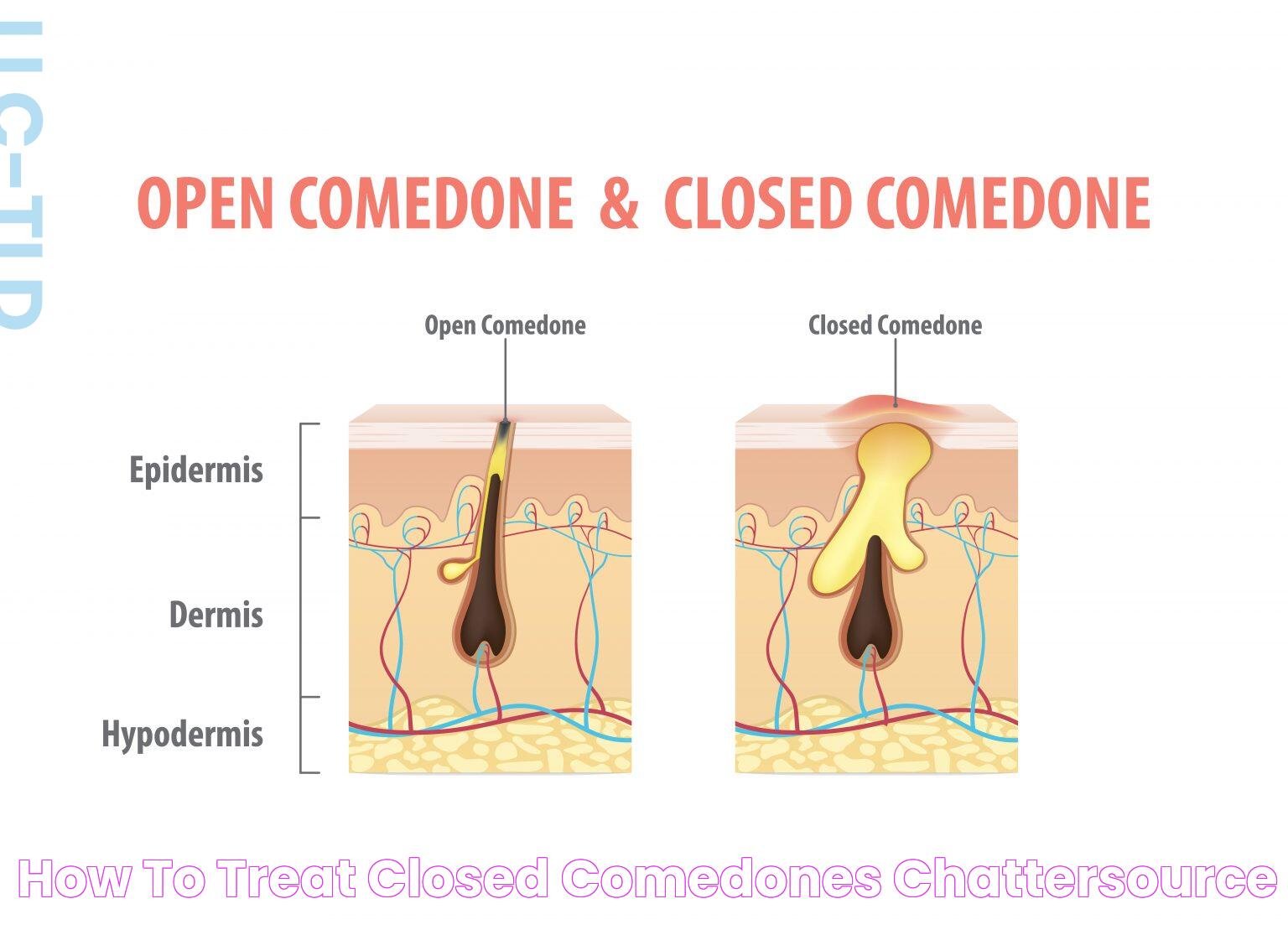 Everything You Need To Know About Closed Comedones On Jawline: Causes, Treatments, And Prevention