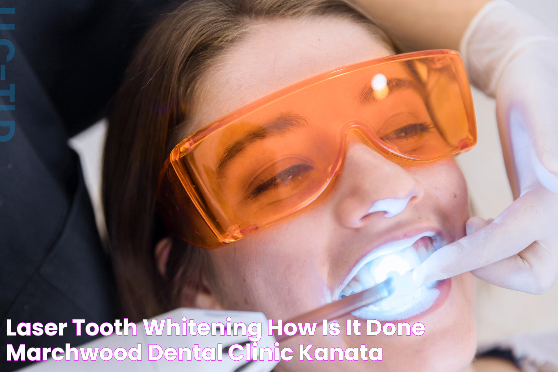 LASER TOOTH WHITENING How is it done? Marchwood Dental Clinic Kanata