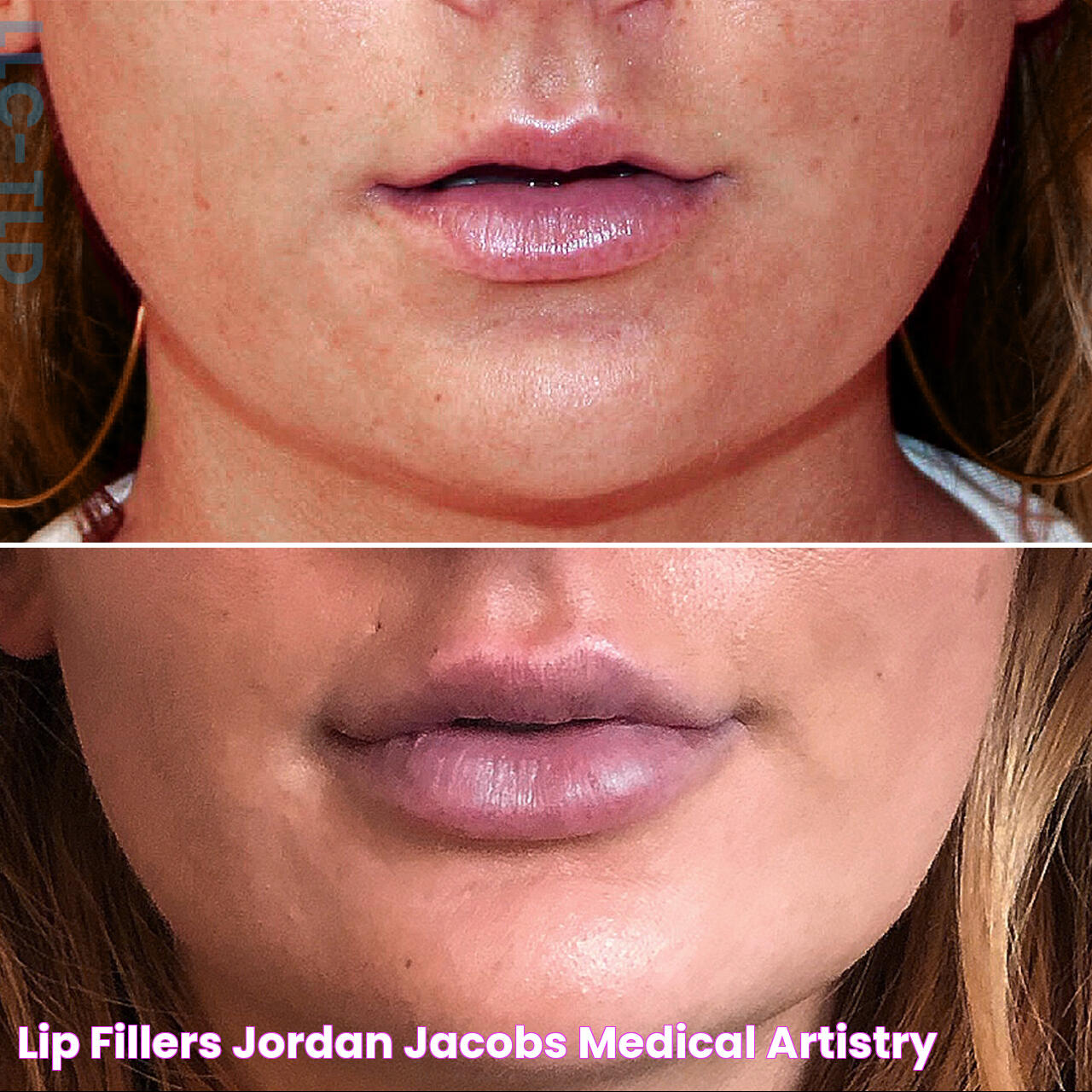 Enhancing Beauty: A Guide To Lip Fillers And Their Visual Appeal