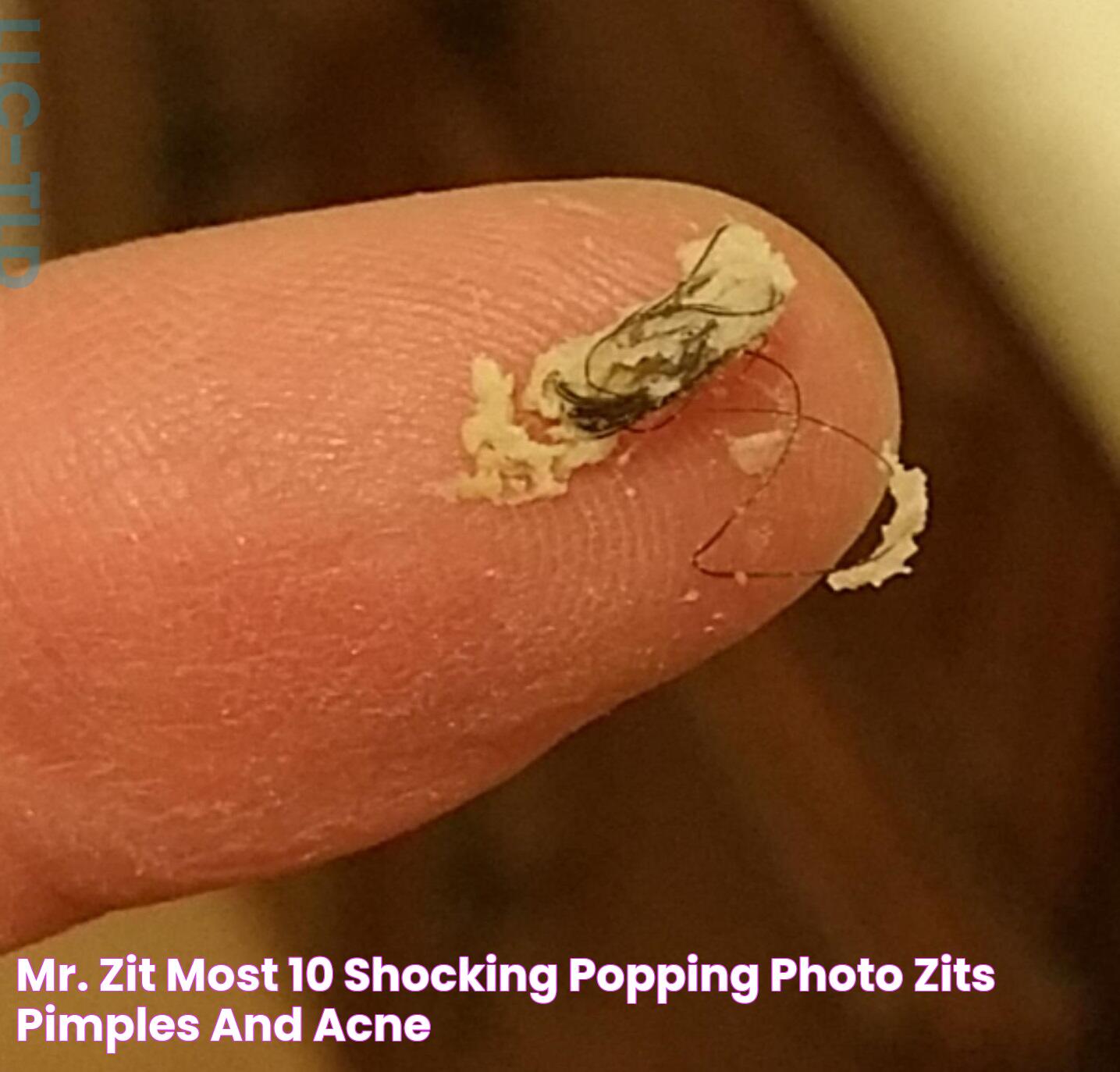 Mr. ZIT Most 10 Shocking Popping Photo ! (Zits , Pimples and Acne)