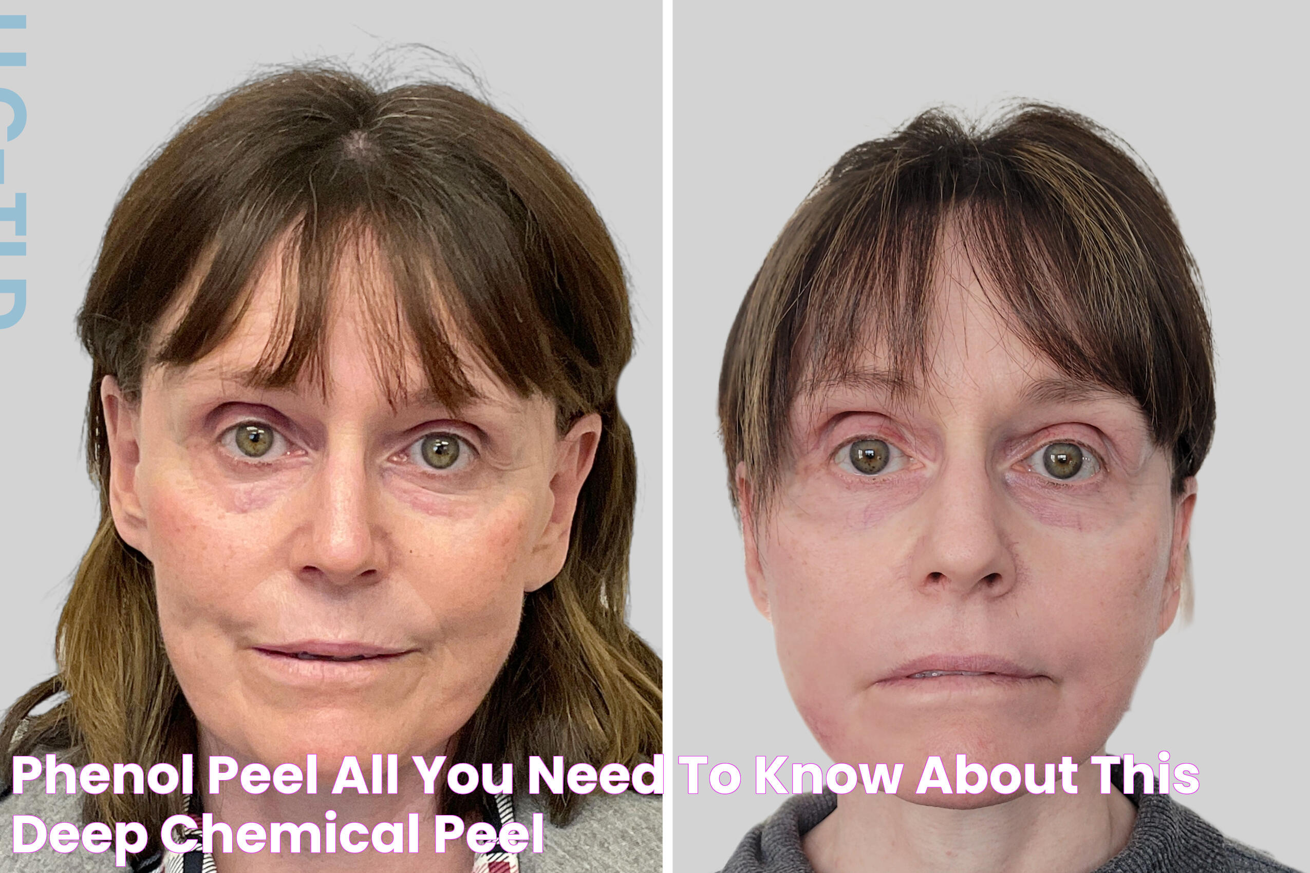 Phenol Peel All You Need to Know About this Deep Chemical Peel