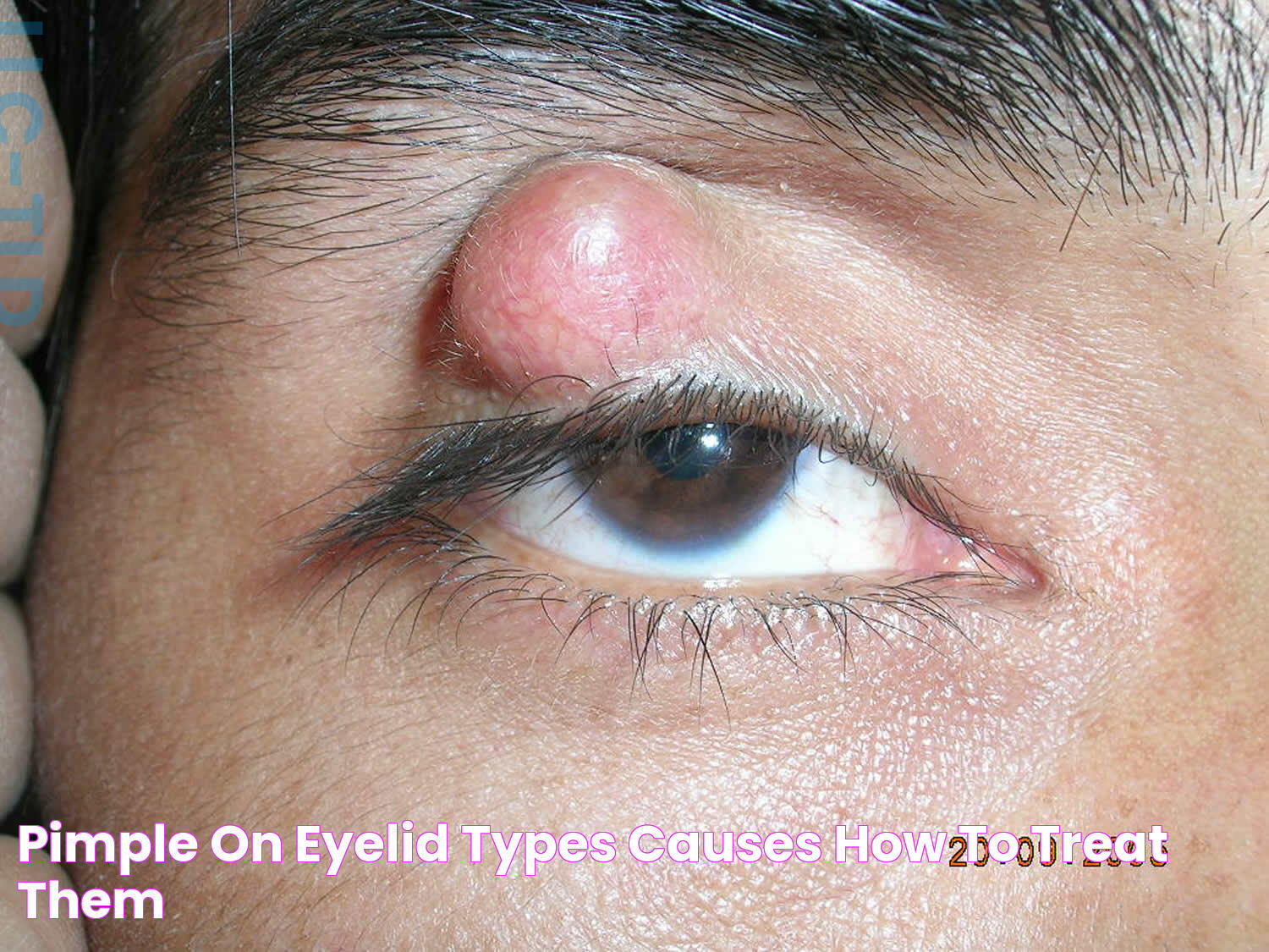 Small White Pimple On Lower Eyelid: Causes, Treatments &amp; Prevention Tips