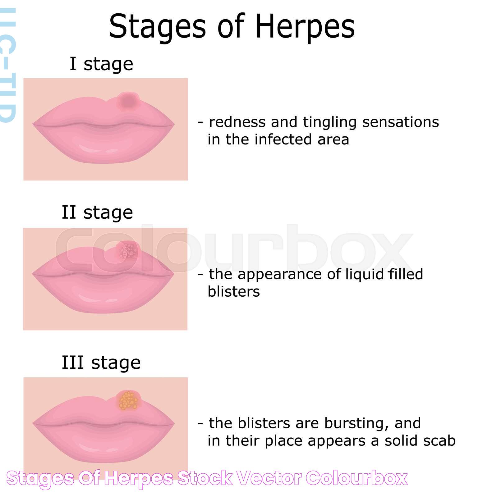 Stages of Herpes Stock vector Colourbox