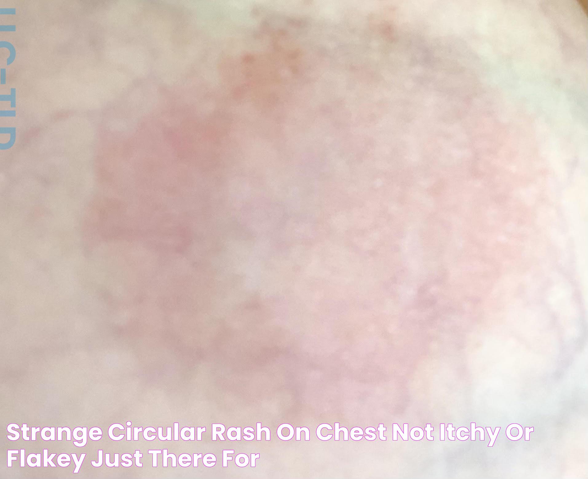 Comprehensive Guide: Rash On Chest Not Itchy - Causes, Diagnosis, And Treatment