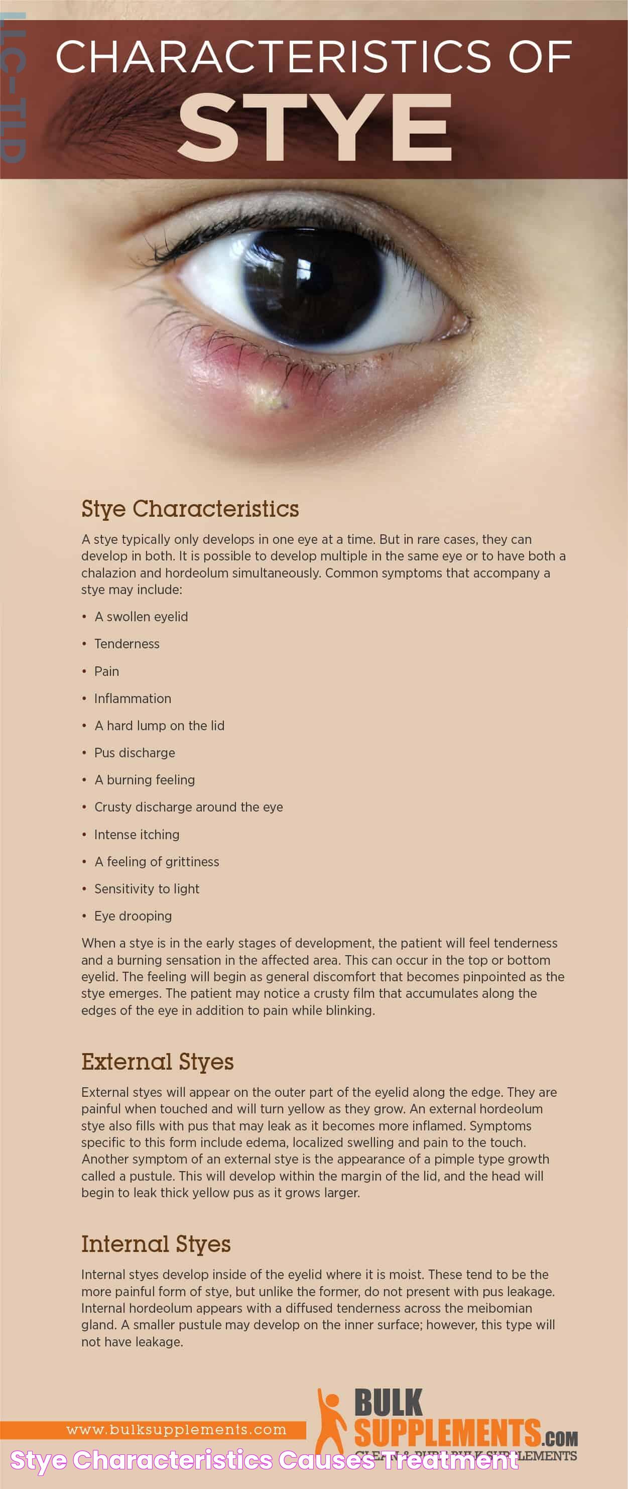 Stye Characteristics, Causes & Treatment