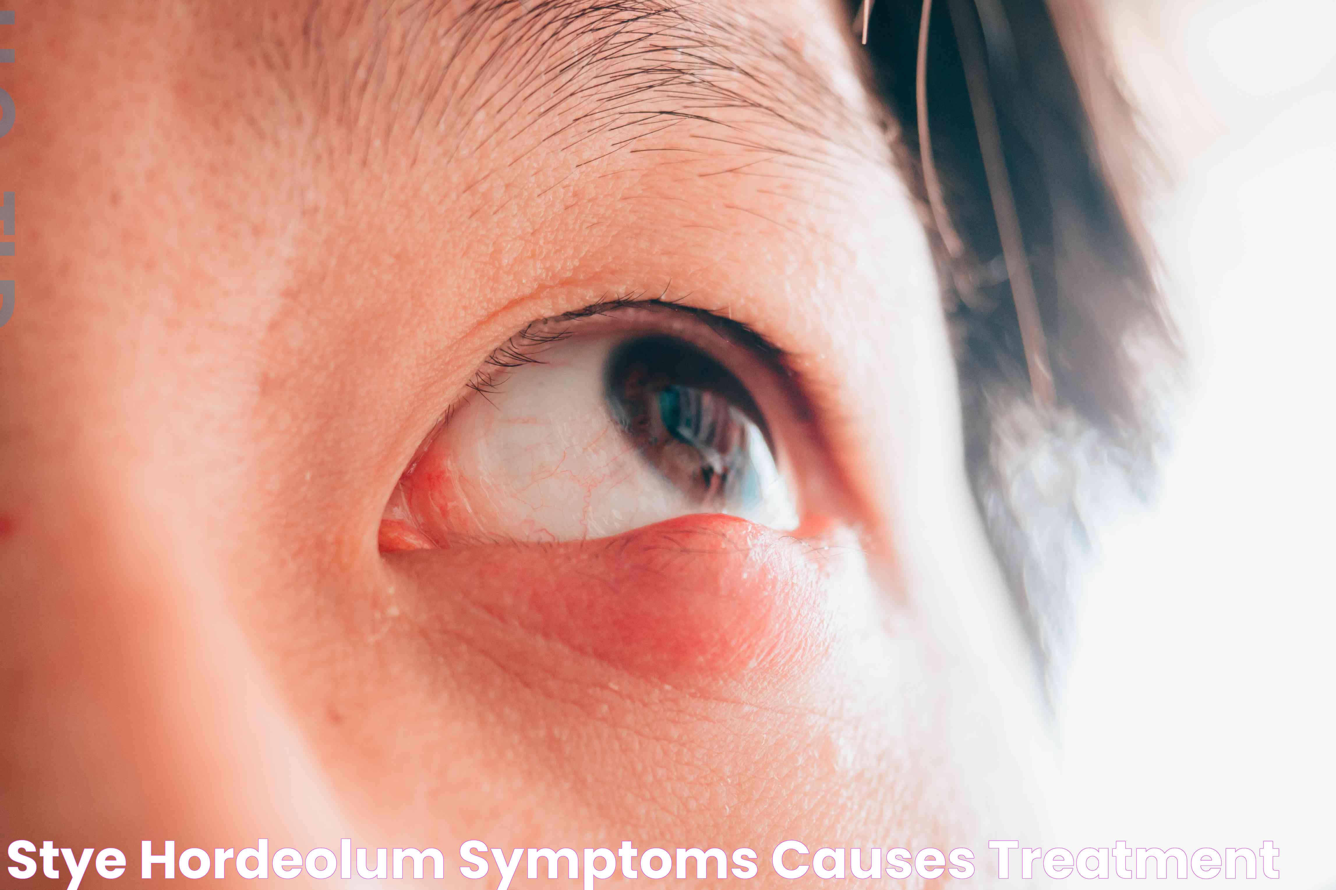 Can You Have A Stye Without A Bump? Insights And Causes