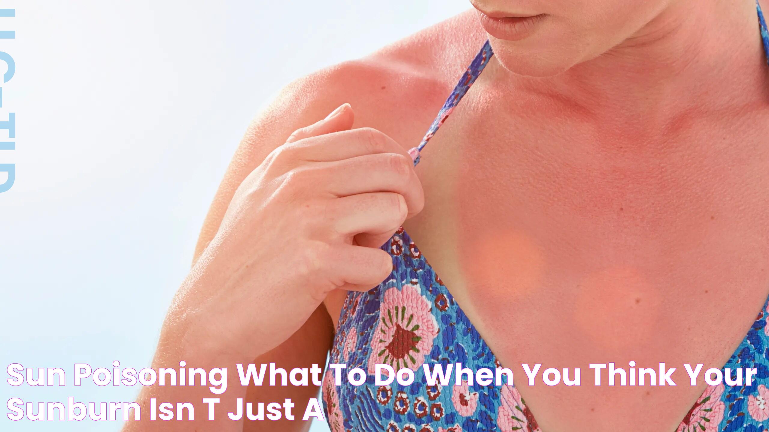 Sun Poisoning What to Do When You Think Your Sunburn Isn't Just a