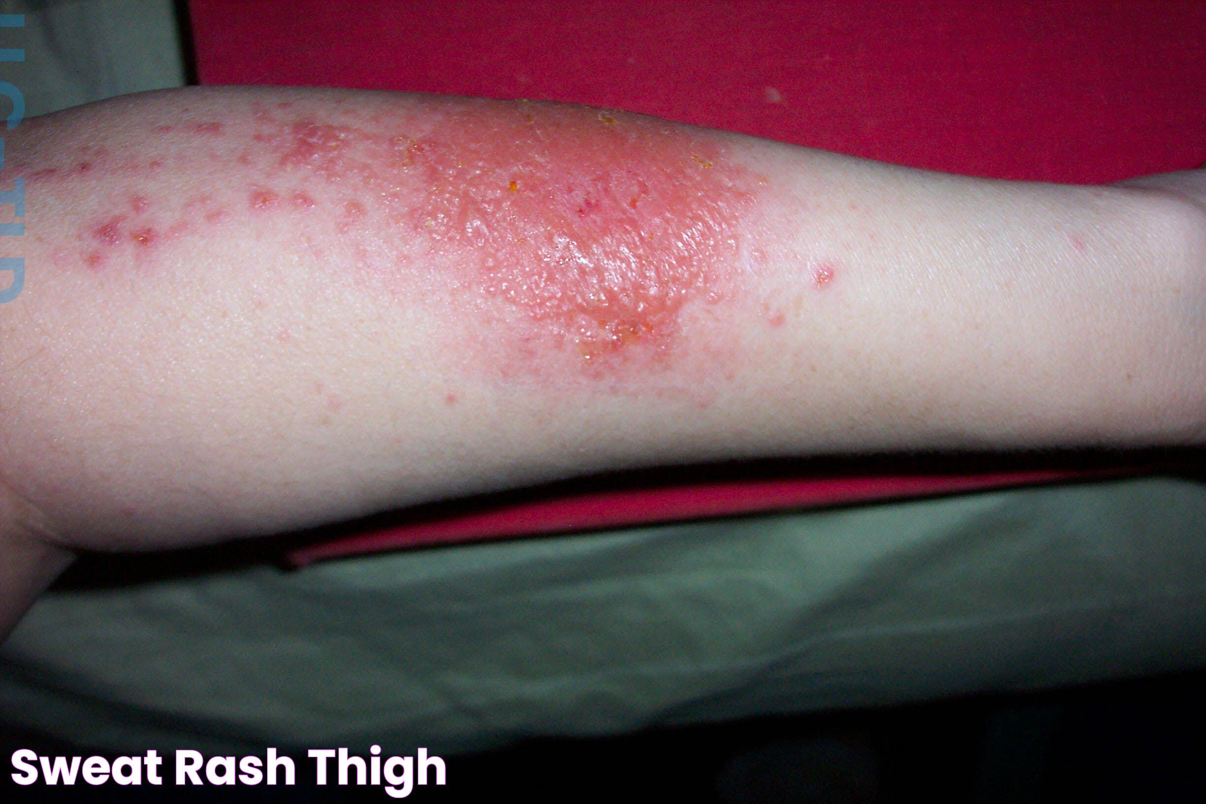 Sweat Rash Thigh