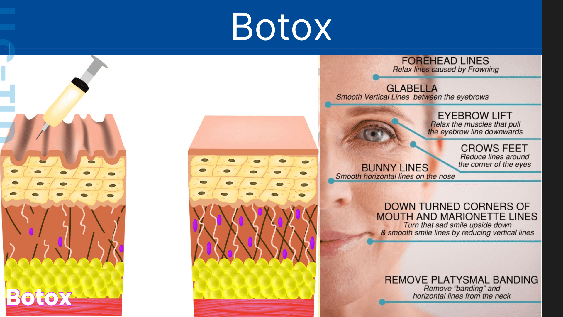 Botox