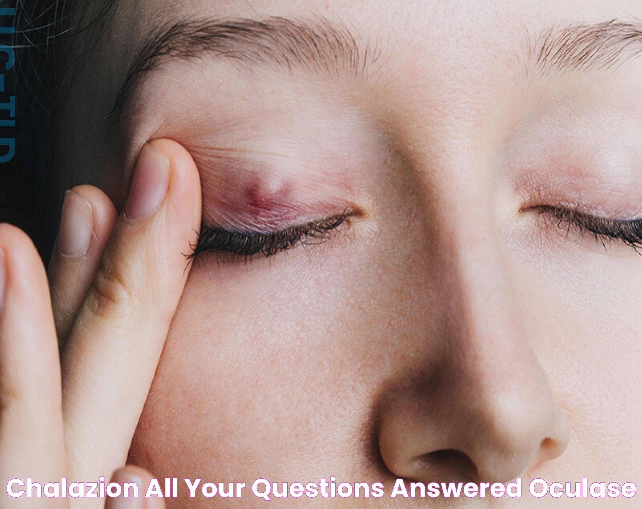 Effective Chalazion Self-Care: Steps To Relief And Recovery