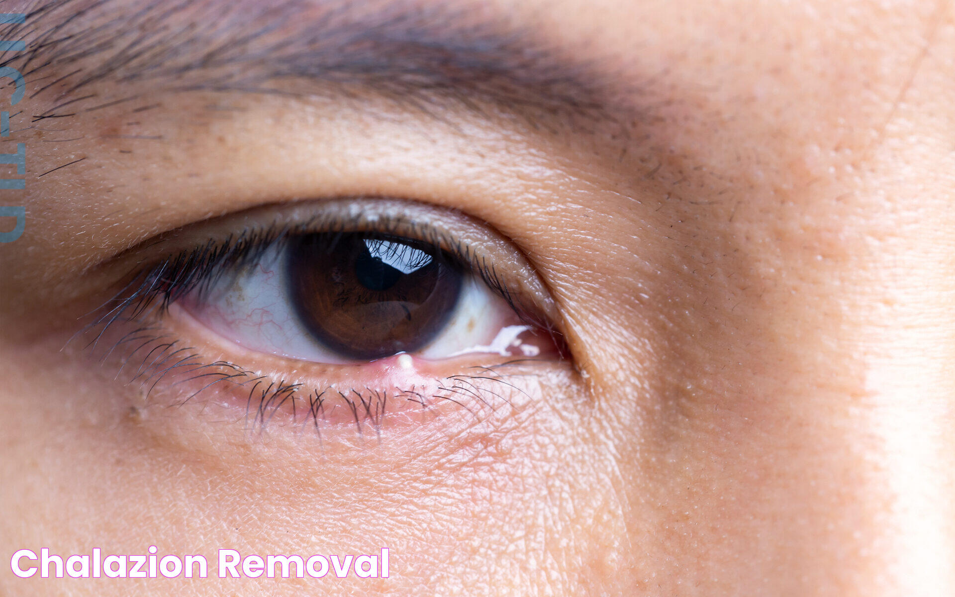 Chalazion Removal