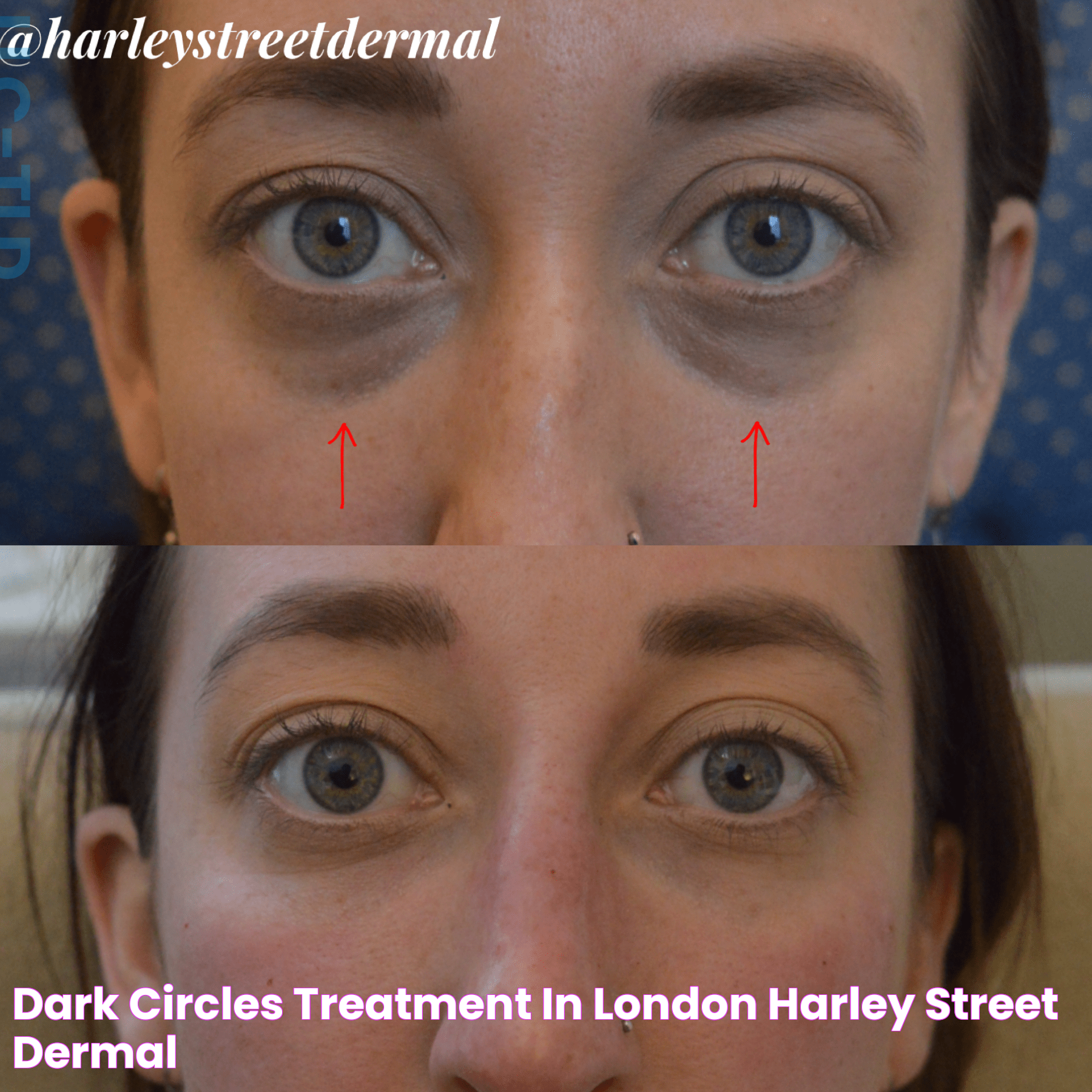 Dark Circles Treatment in London Harley Street Dermal