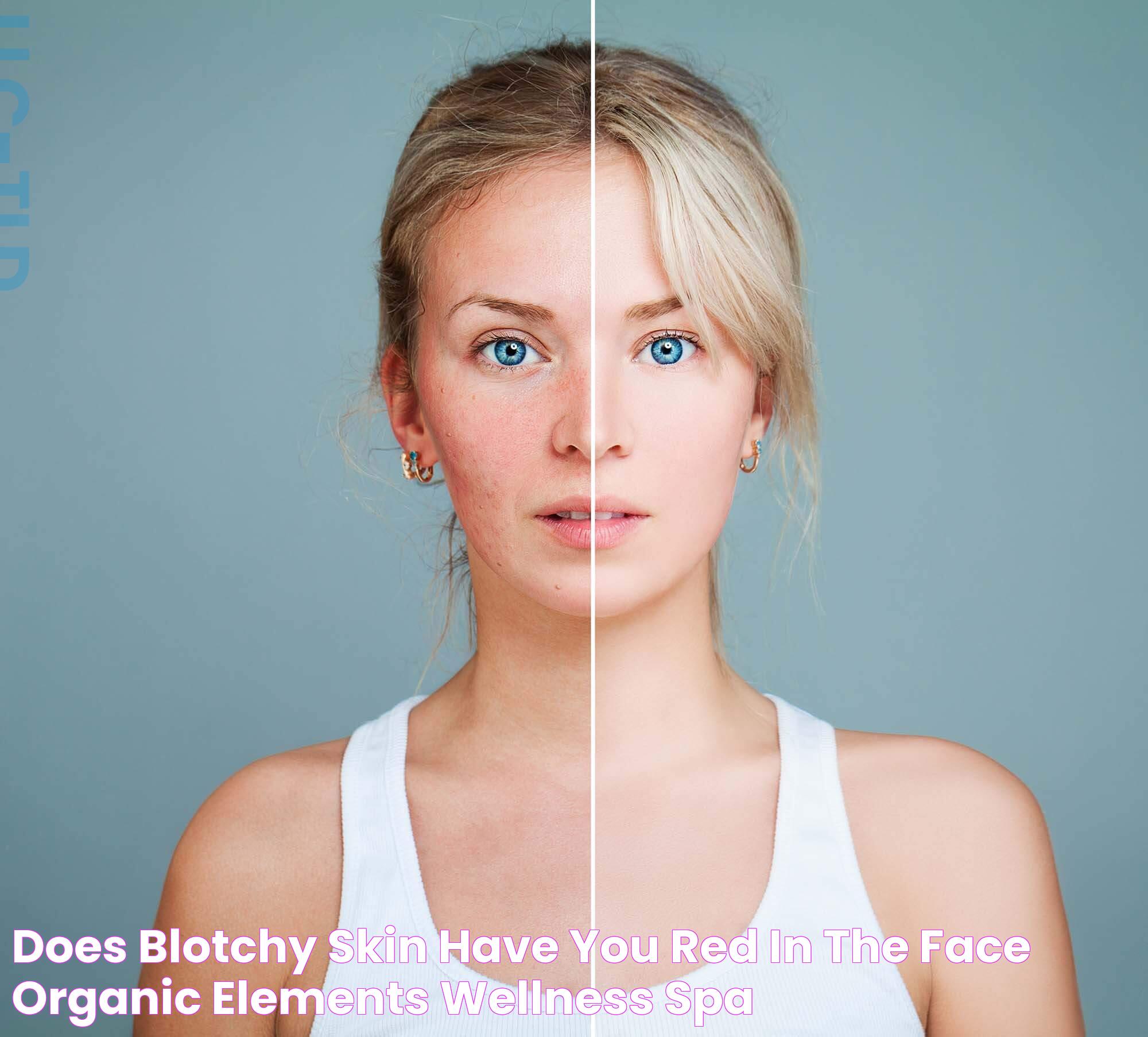 Does Blotchy Skin Have You Red in the Face? Organic Elements Wellness Spa