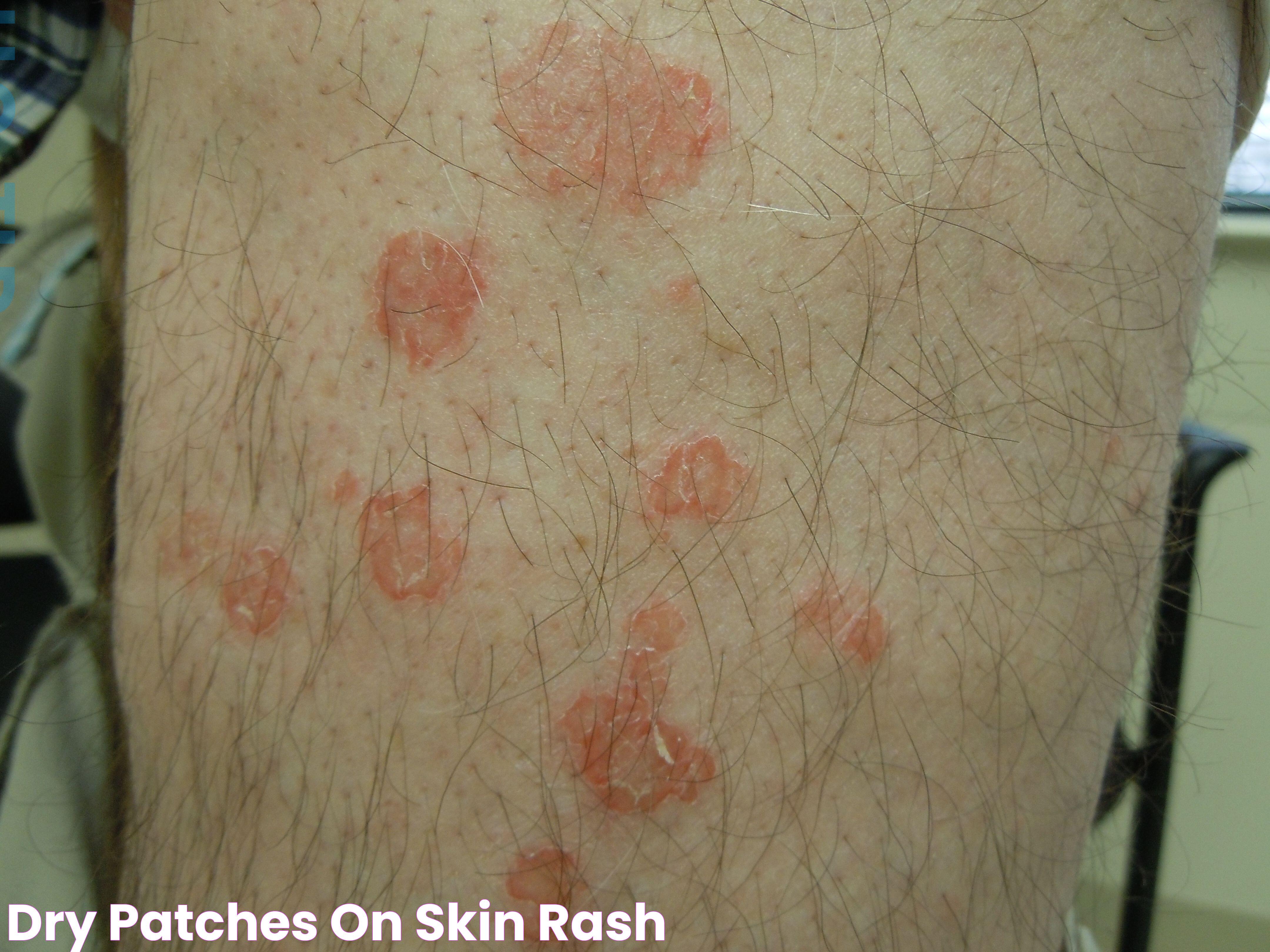 Dry Patches On Skin Rash