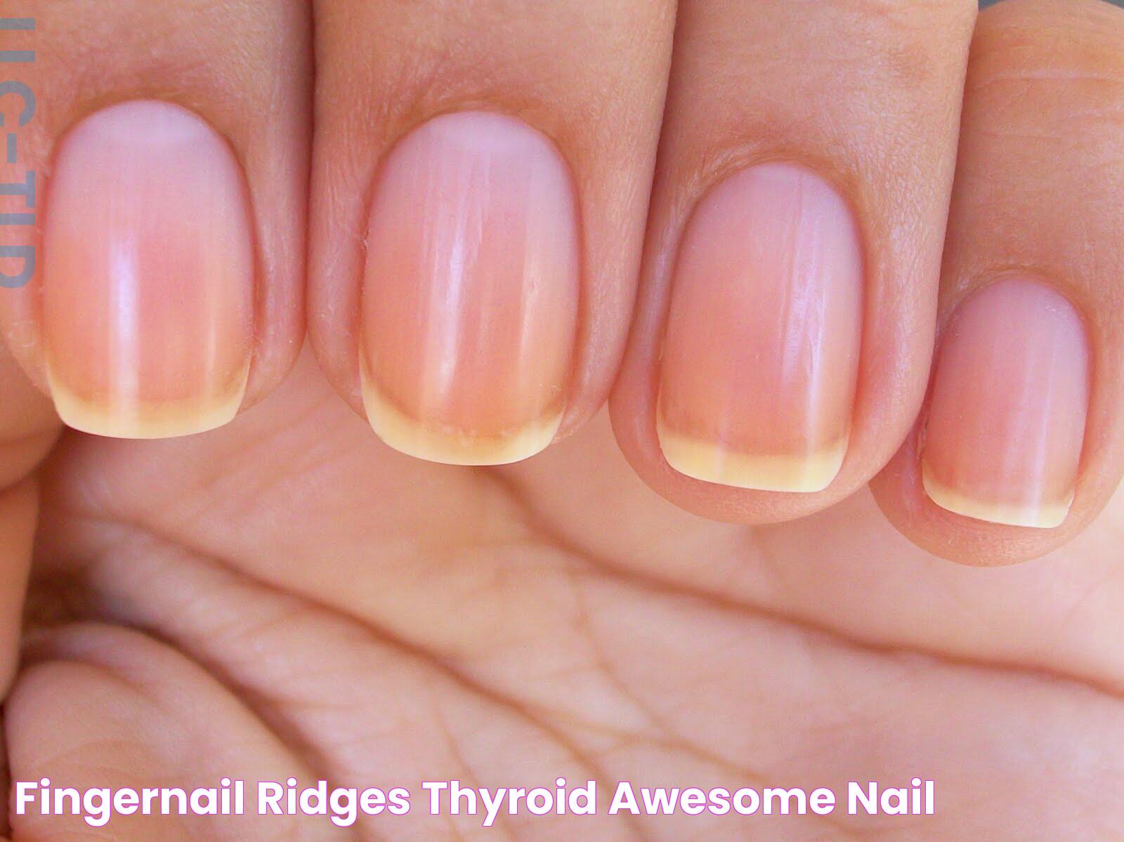 Fingernail ridges thyroid Awesome Nail