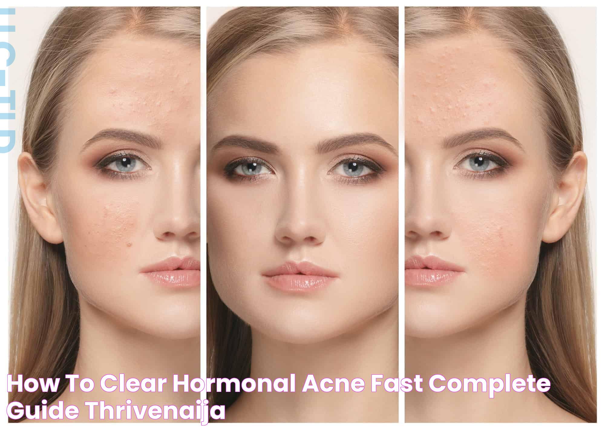 Quick Solutions To Clear Up Hormonal Acne Fast