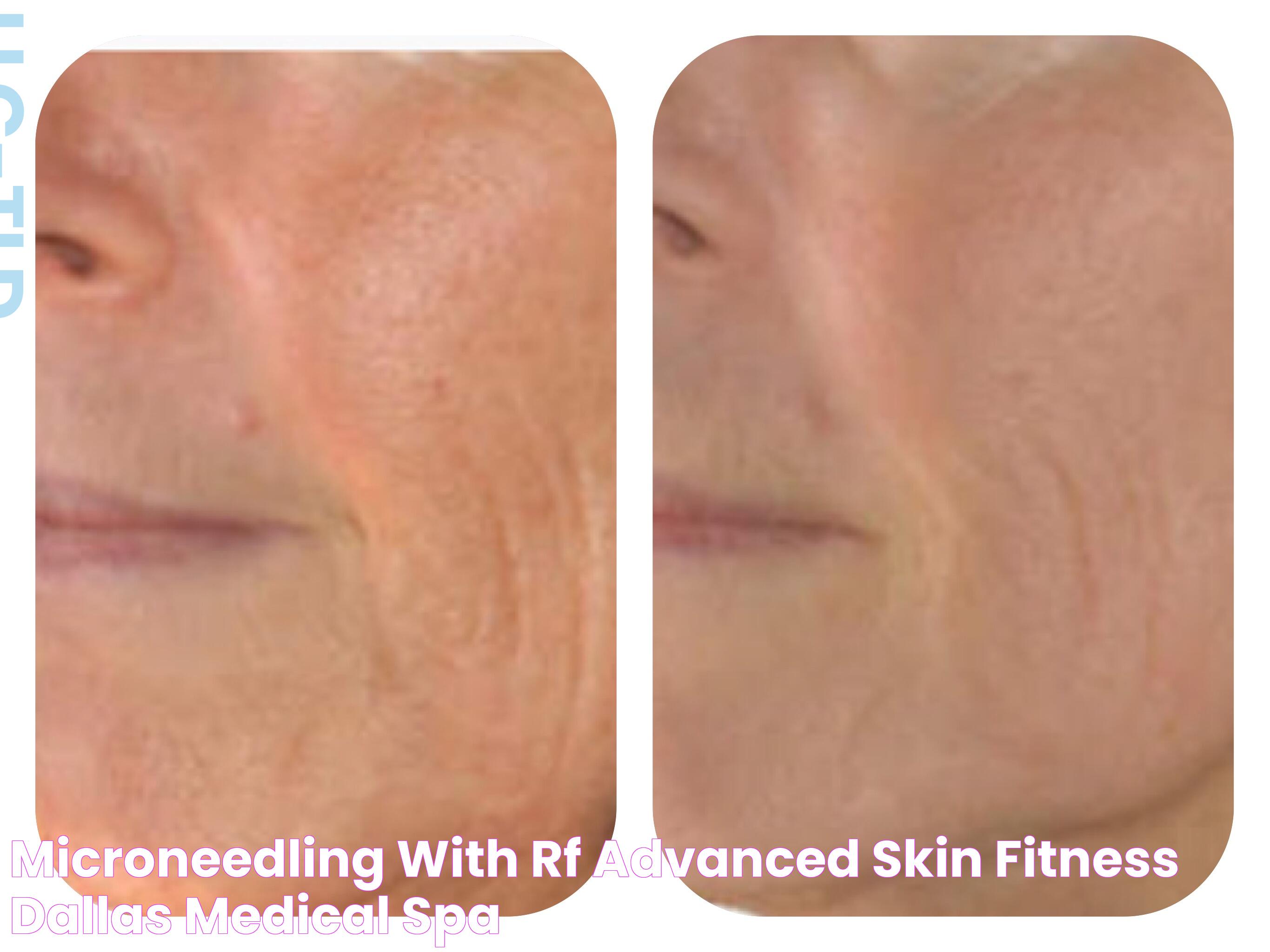 MicroNeedling with RF Advanced Skin Fitness Dallas Medical Spa