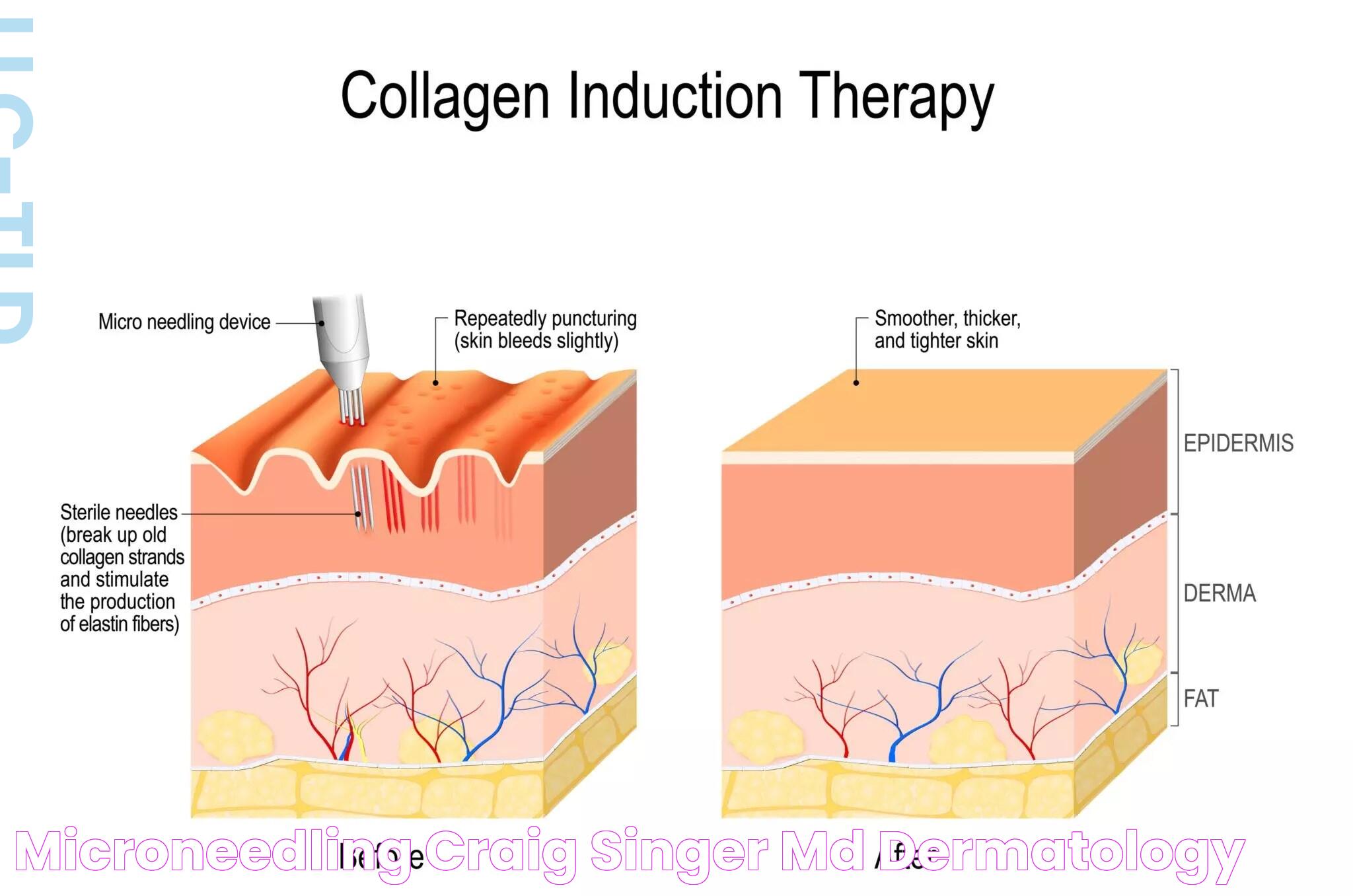 Micro Needling Risks: A Deep Dive Into Potential Concerns