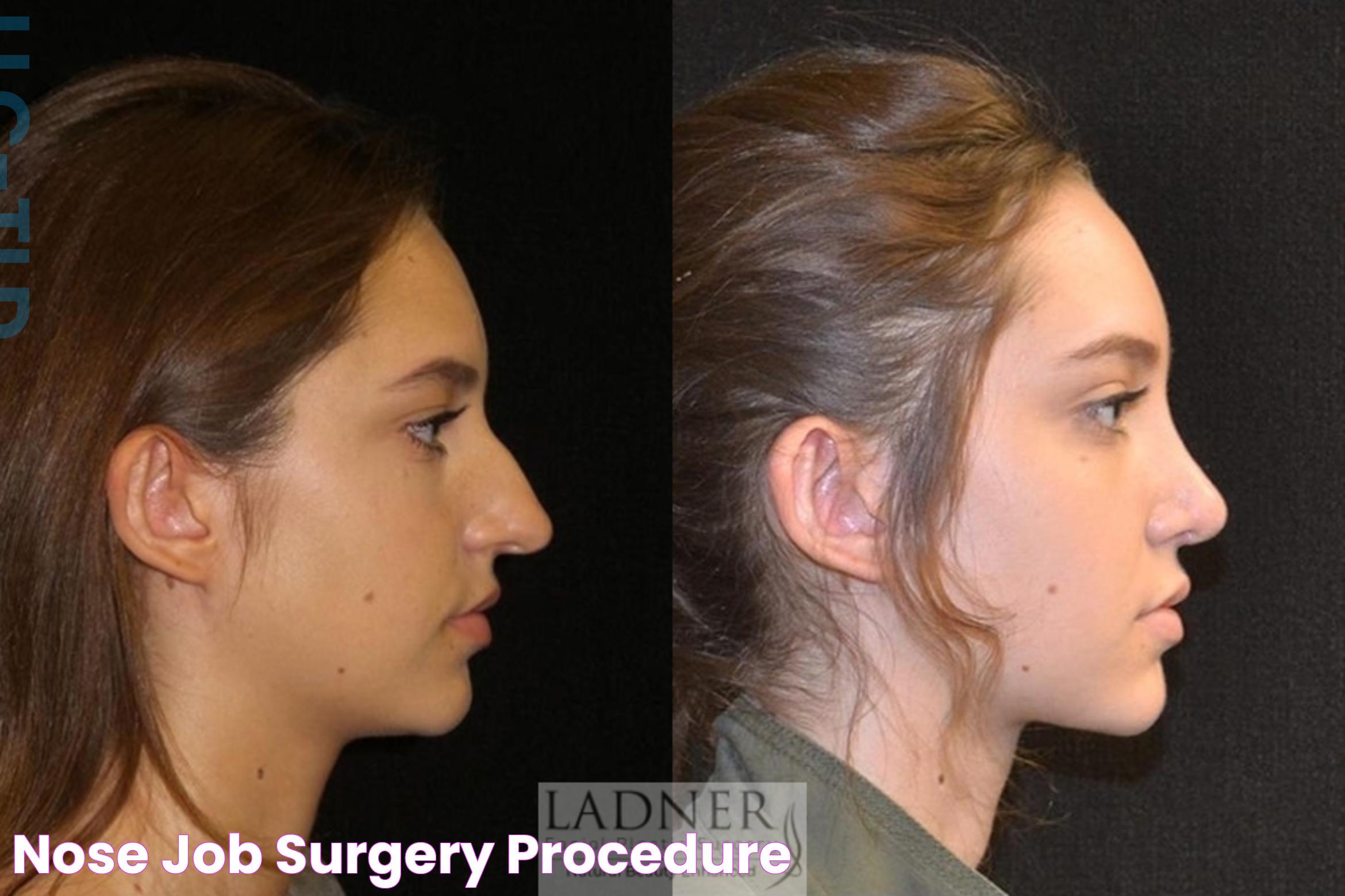 Enhancing Your Appearance: Nose Surgery Procedure Explained