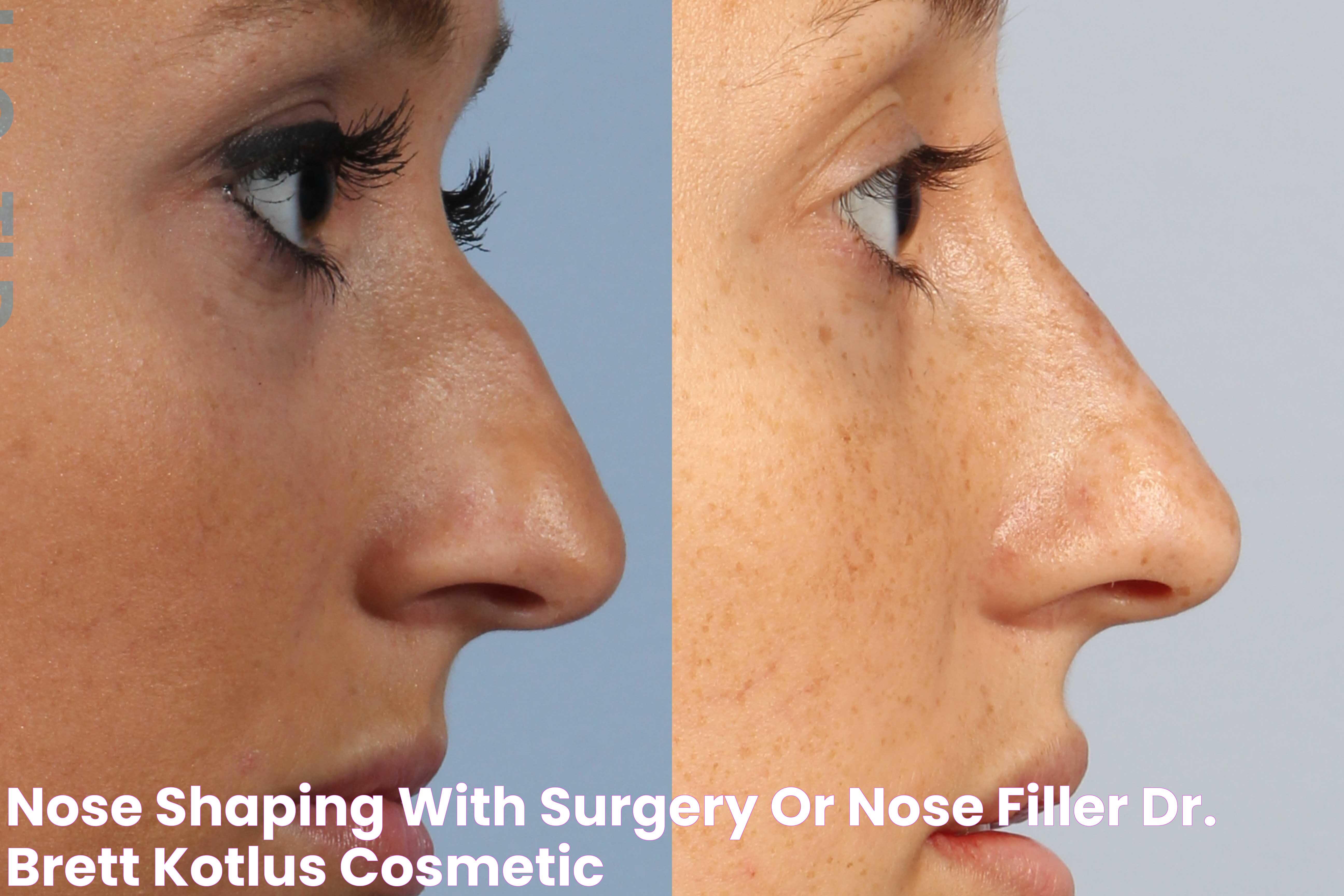 Nose Shaping With Surgery or Nose Filler? Dr. Brett Kotlus, Cosmetic