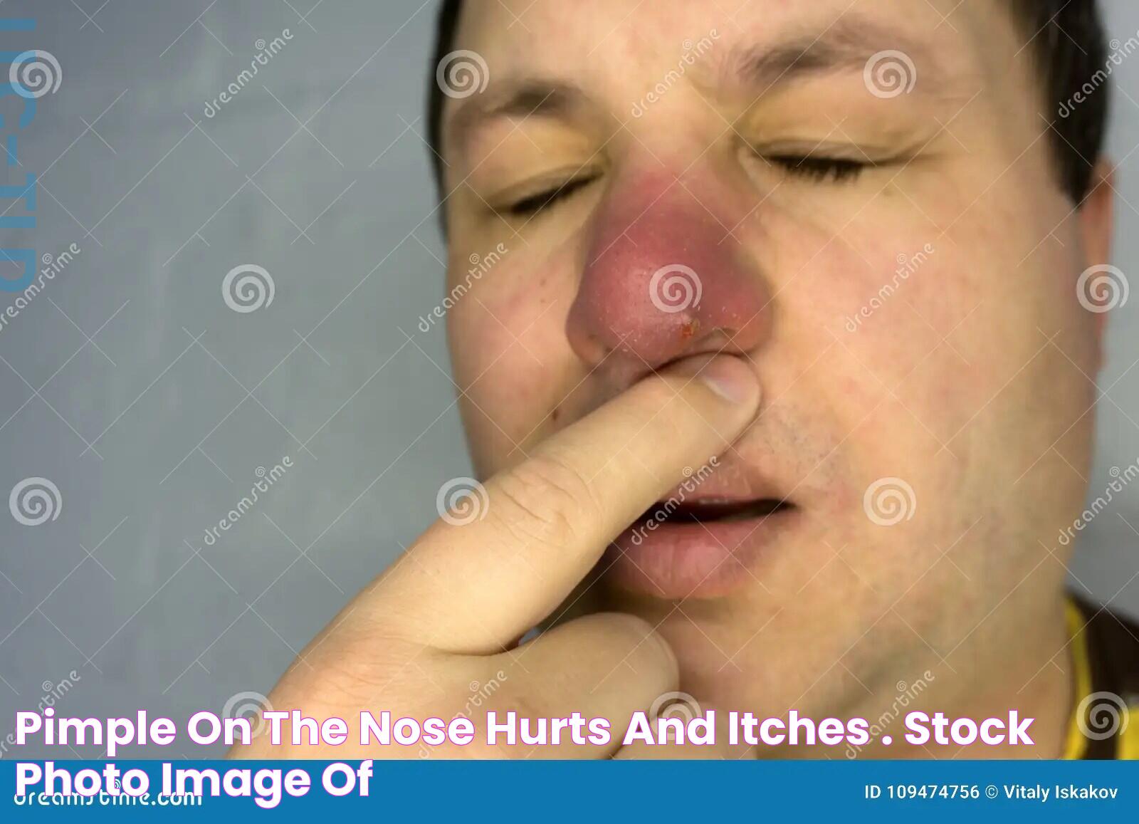 Pimple on the Nose Hurts and Itches . Stock Photo Image of