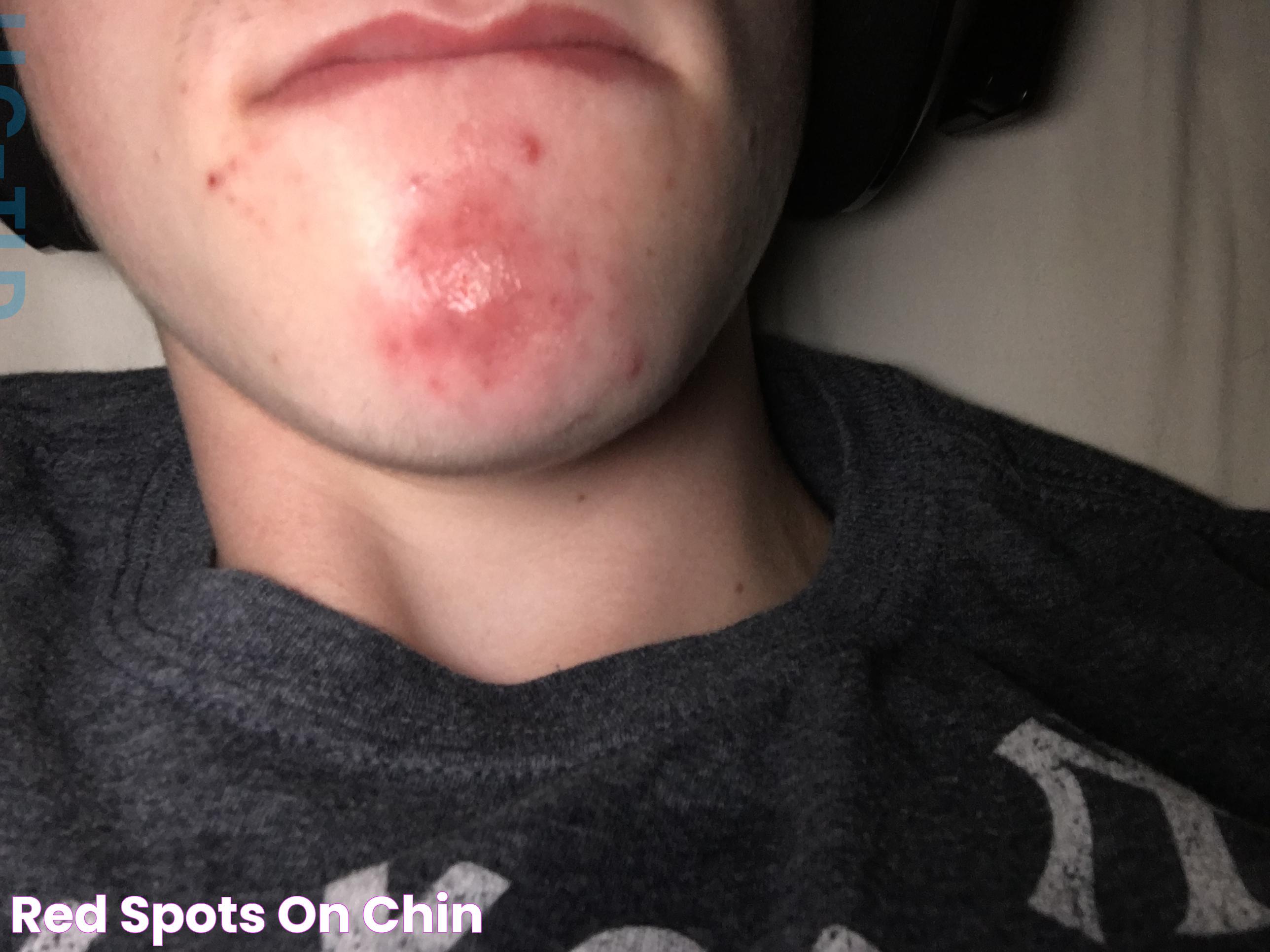 Red Spots On Chin