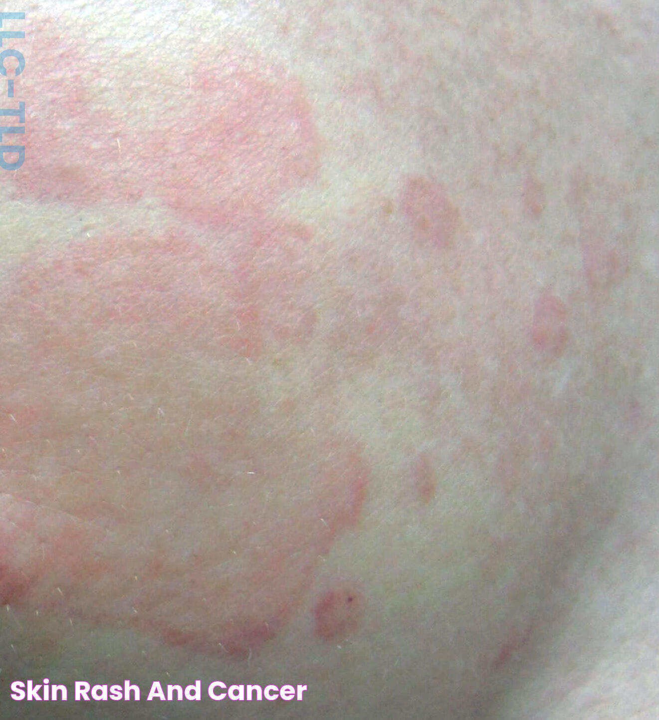 Spotty Rash On Body: Causes, Symptoms, And Treatment Options