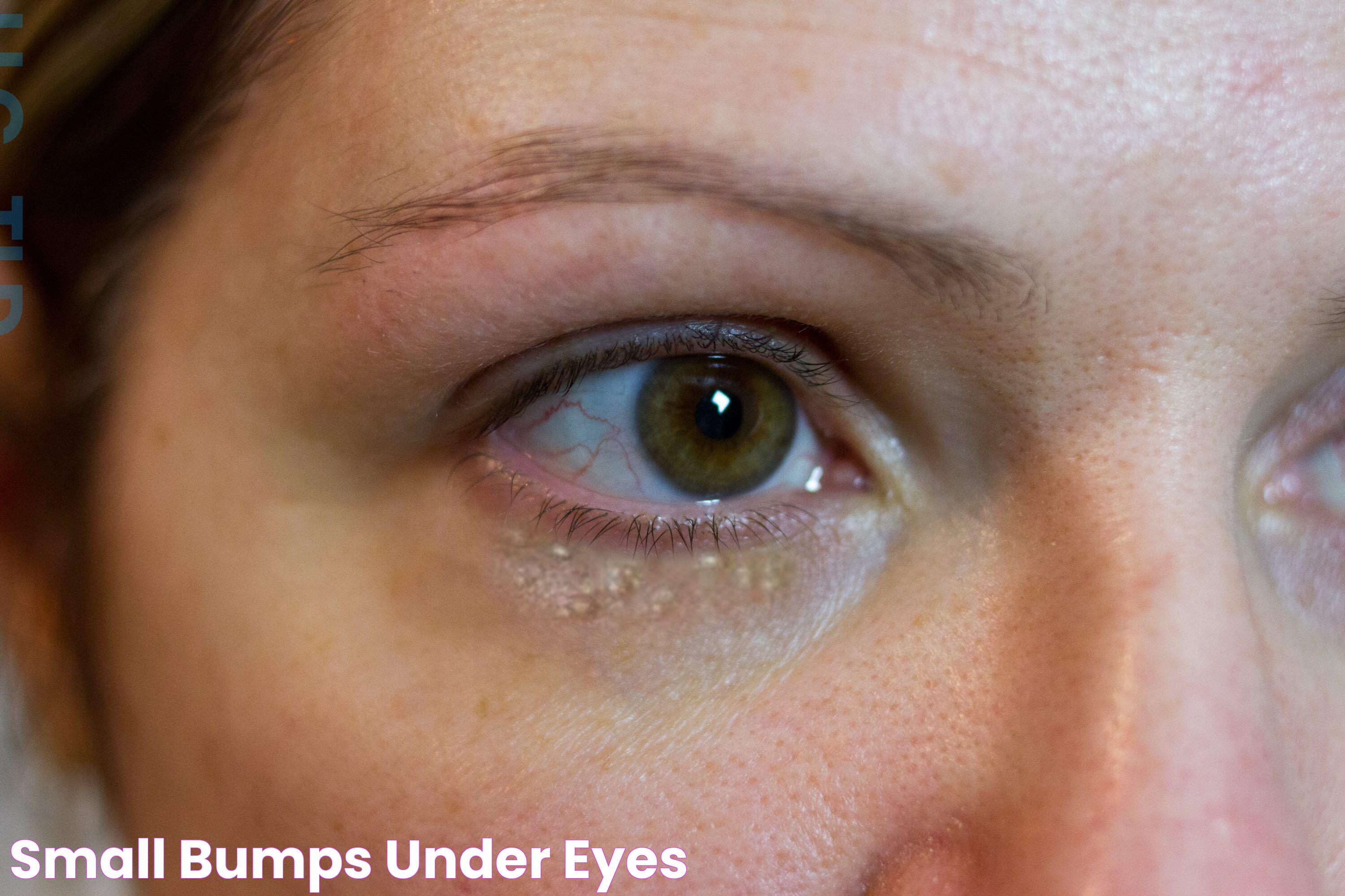 Small Bumps Under Eyes