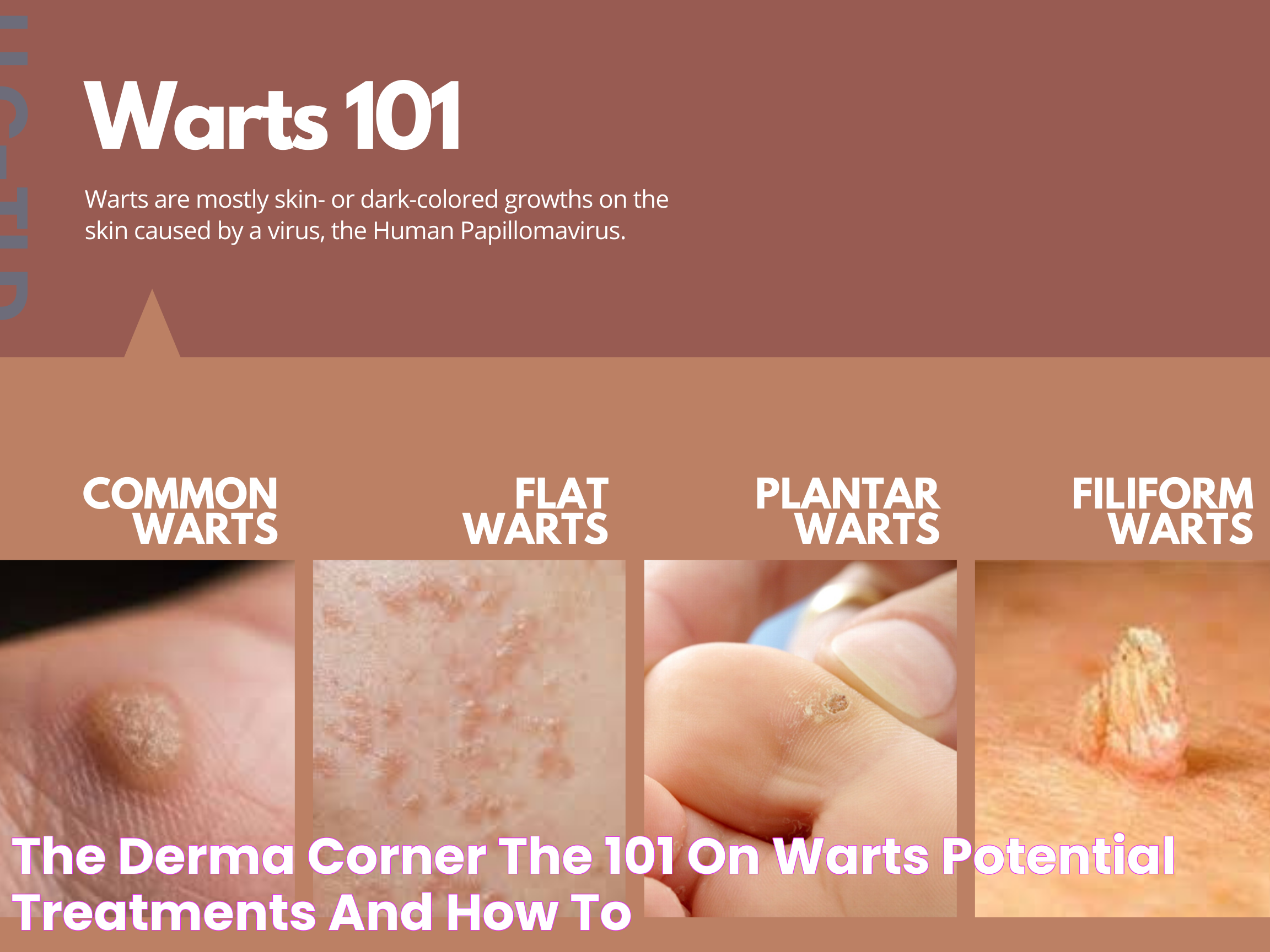 Understanding Different Types Of Warts: A Comprehensive Guide