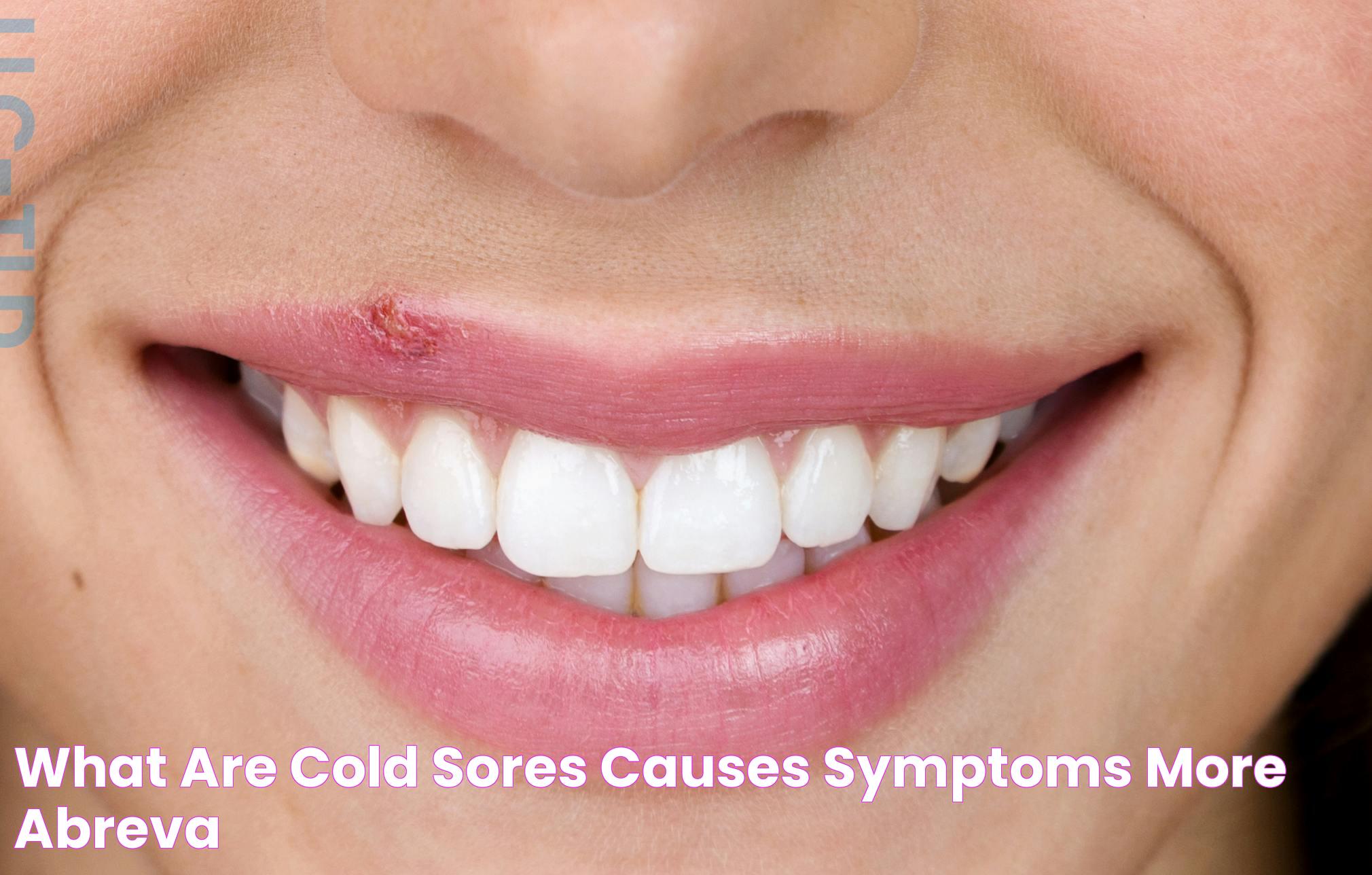 Do Cold Sores Have Pus? Everything You Need To Know