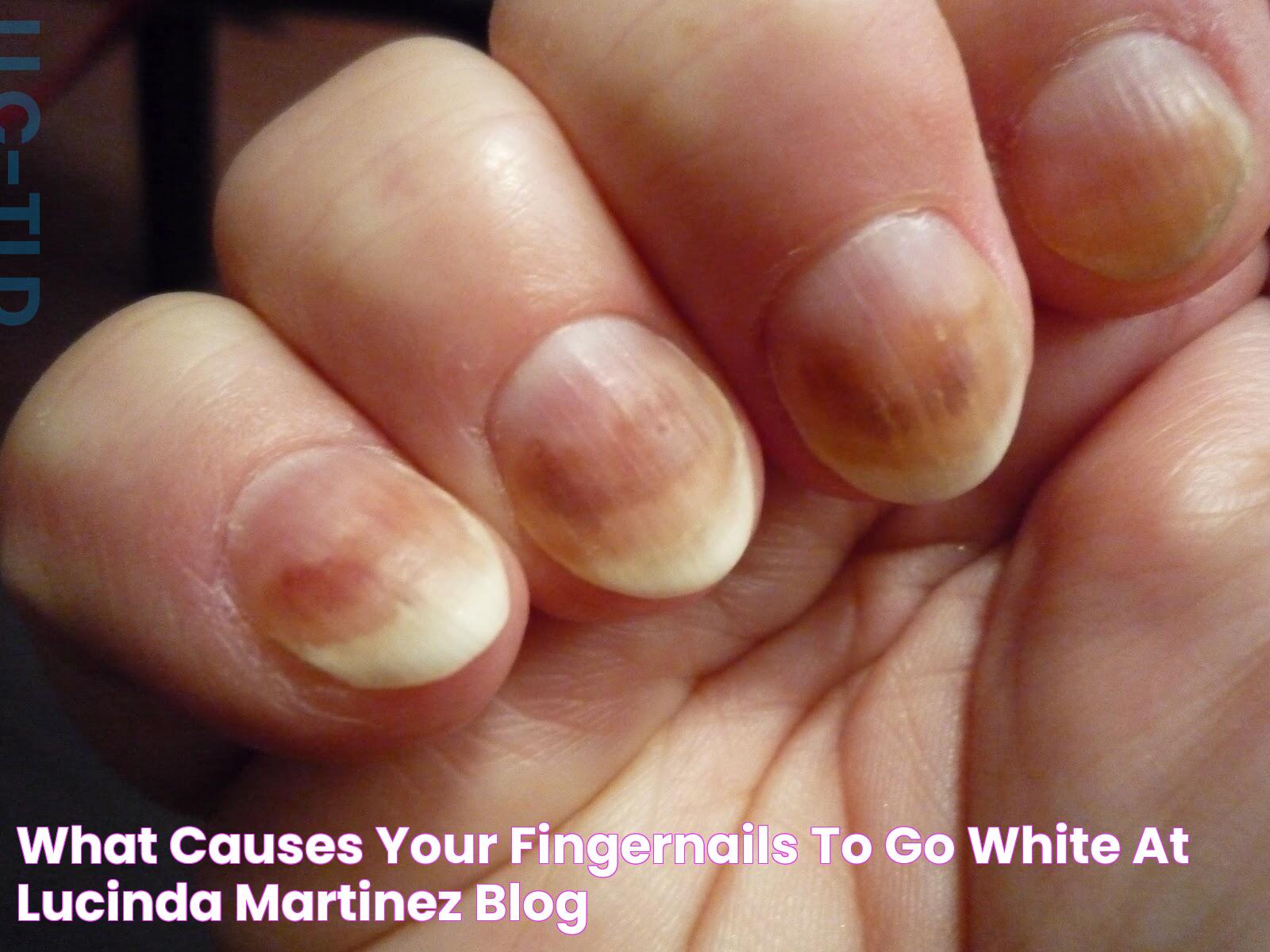 What Causes Your Fingernails To Go White at Lucinda Martinez blog