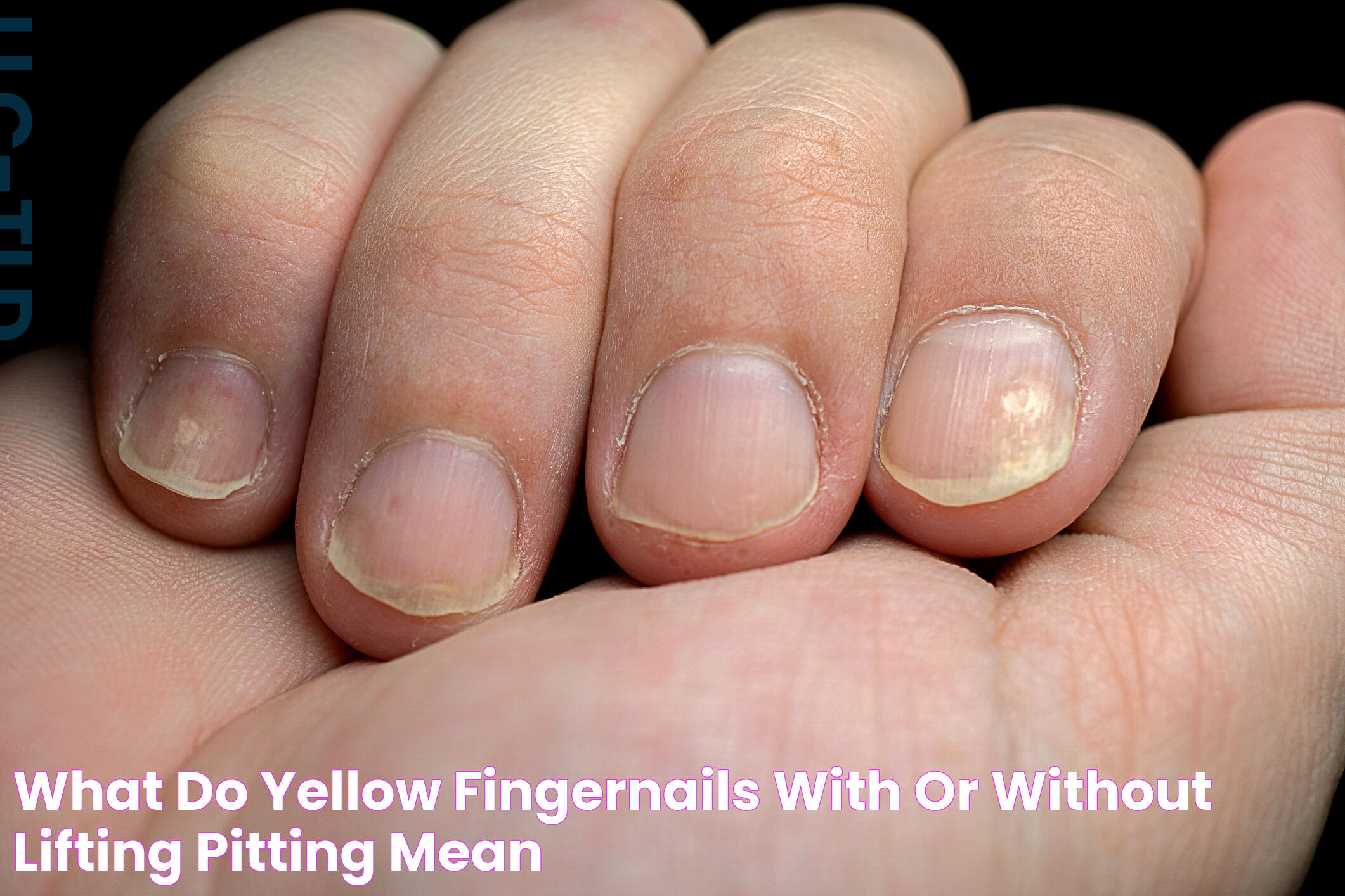 What Do Yellow Fingernails (With or Without Lifting + Pitting) Mean