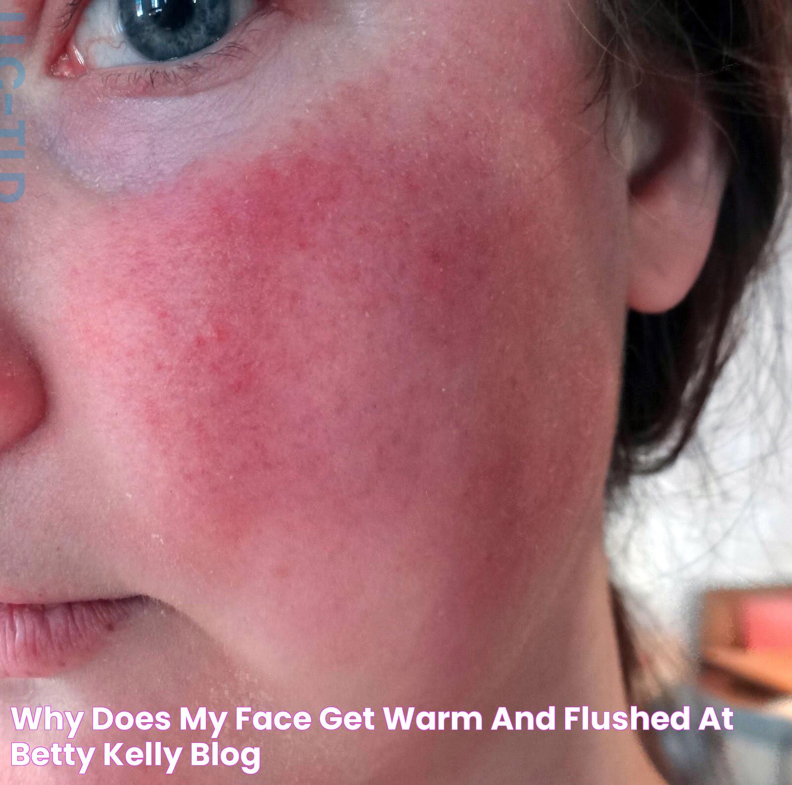 Why Does My Face Get Warm And Flushed at Betty Kelly blog