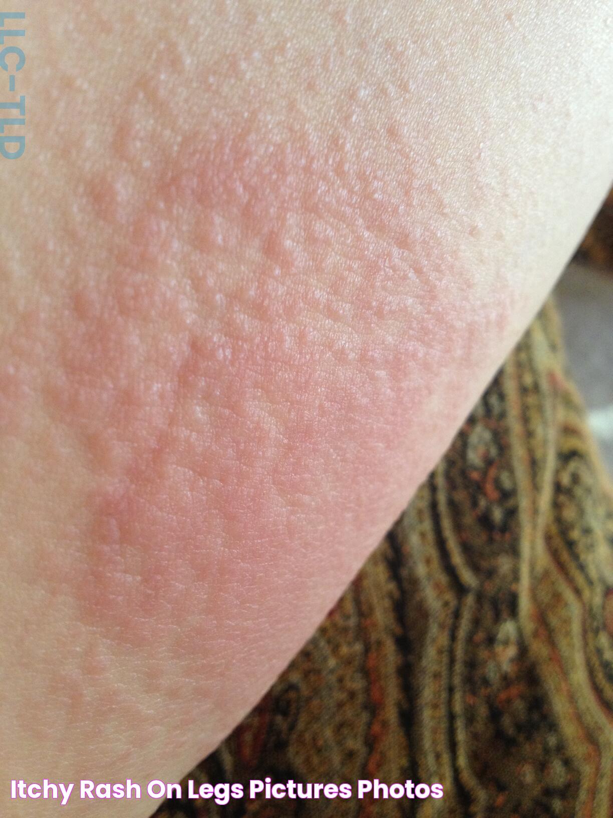 Effective Solutions For Legs Rubbing Rash: Causes, Prevention, And Treatment