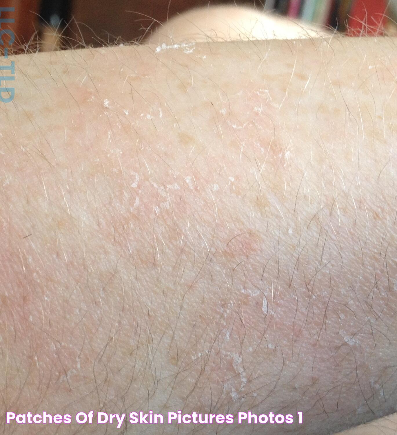 patches of dry skin pictures, photos