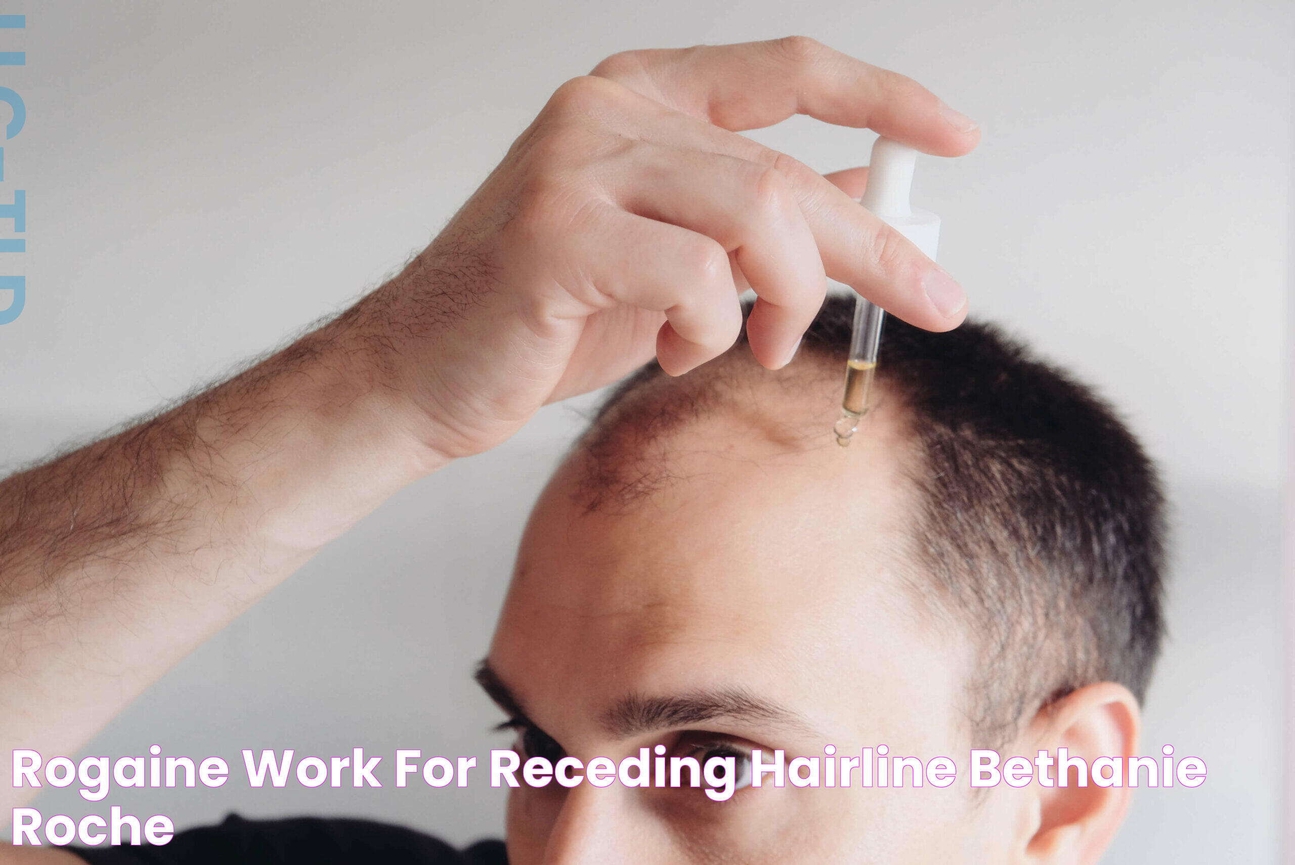 rogaine work for receding hairline Bethanie Roche